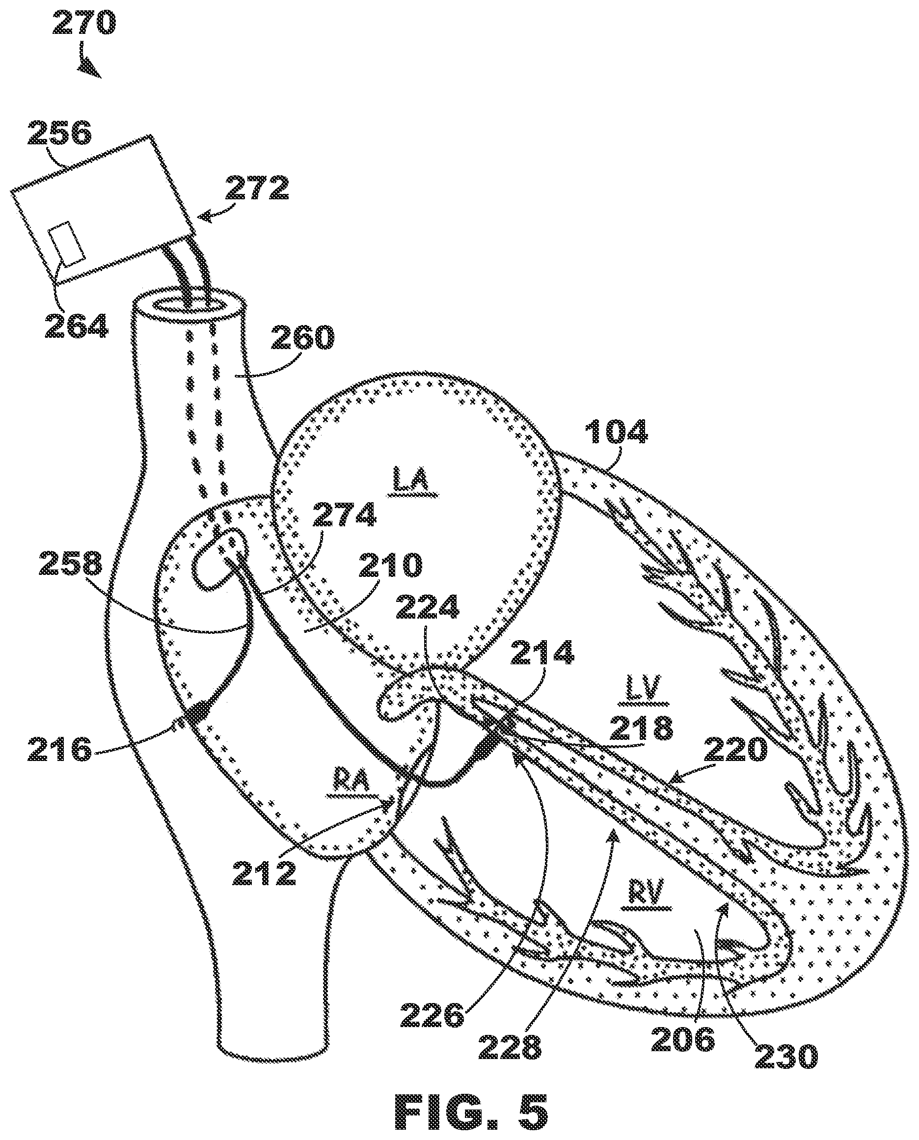 Patent US12350500 Figure 5 – AV synchronous septal pacing