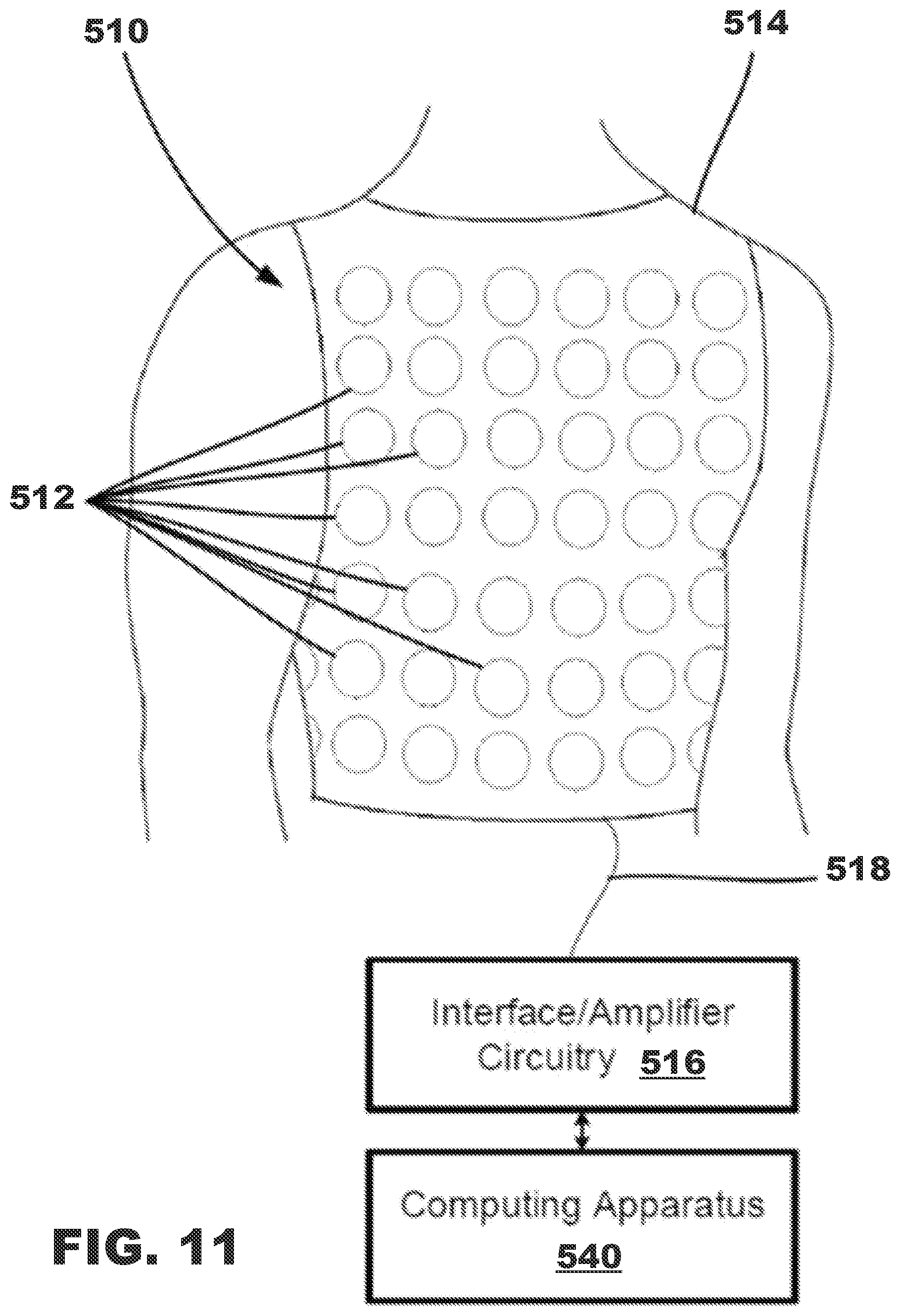 Patent US12350500 Figure 11 – AV synchronous septal pacing
