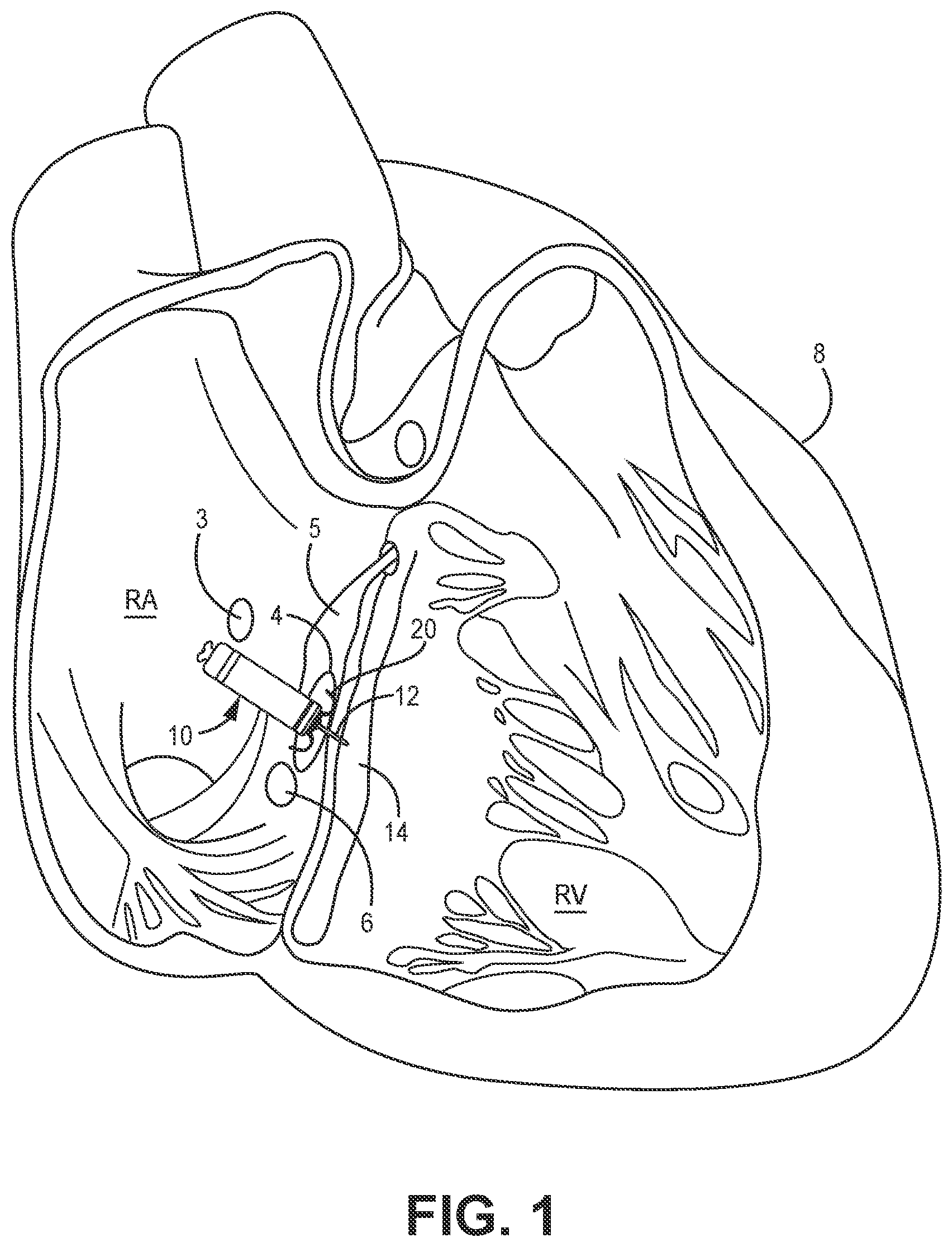 Patent US12350502 Figure 1 – Electrodes for intra-cardiac pacemaker
