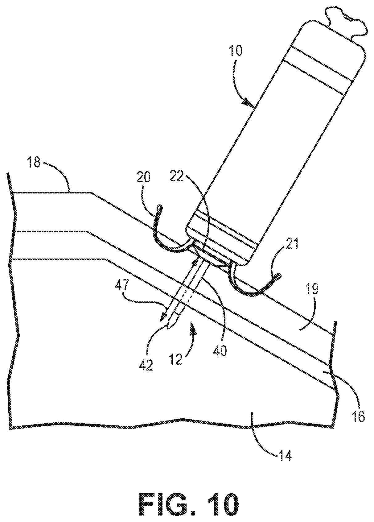 Patent US12350502 Figure 8 – Electrodes for intra-cardiac pacemaker