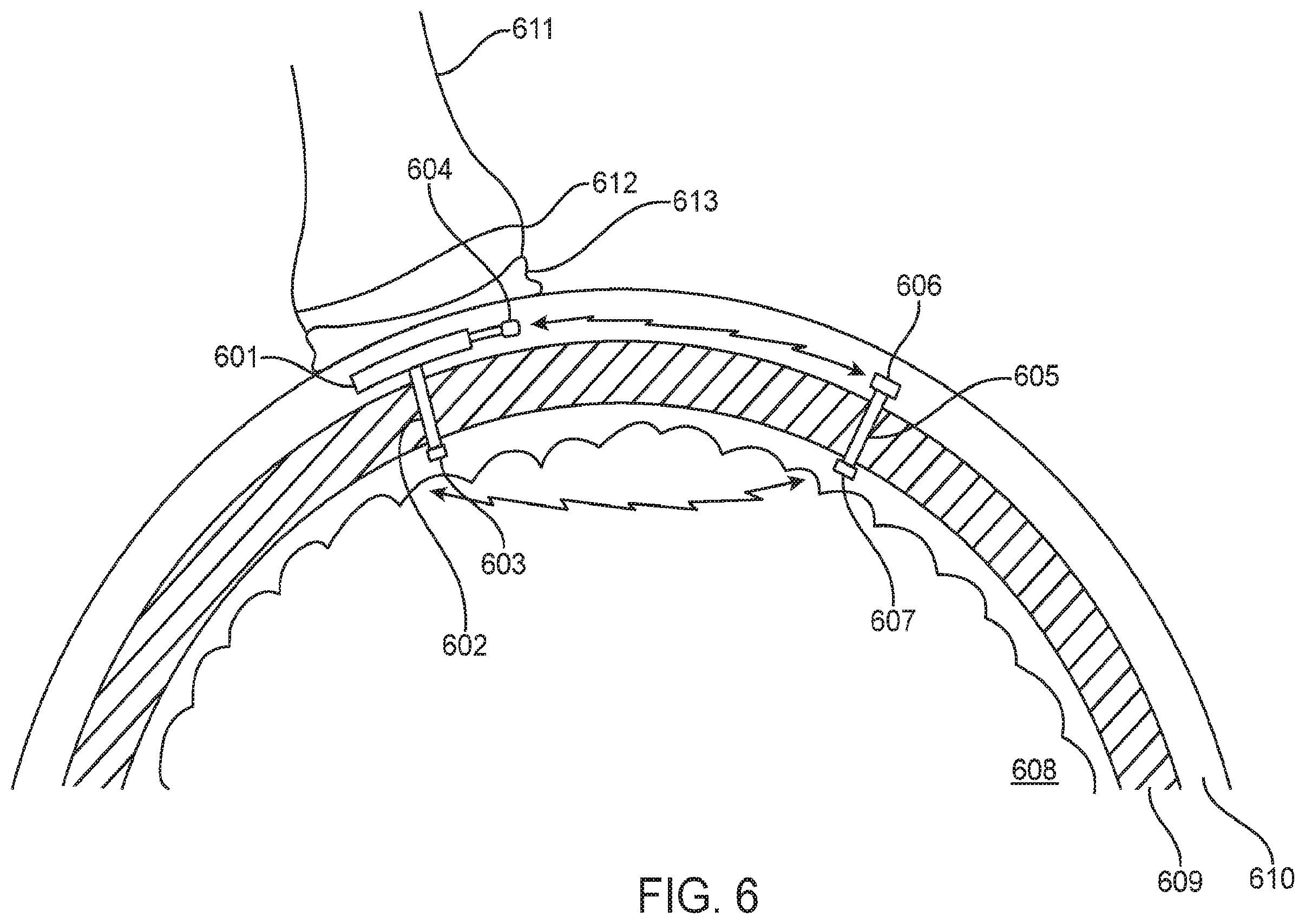 Patent US12350504 Figure 6 – System and method for transcranial current loop brain stimulation