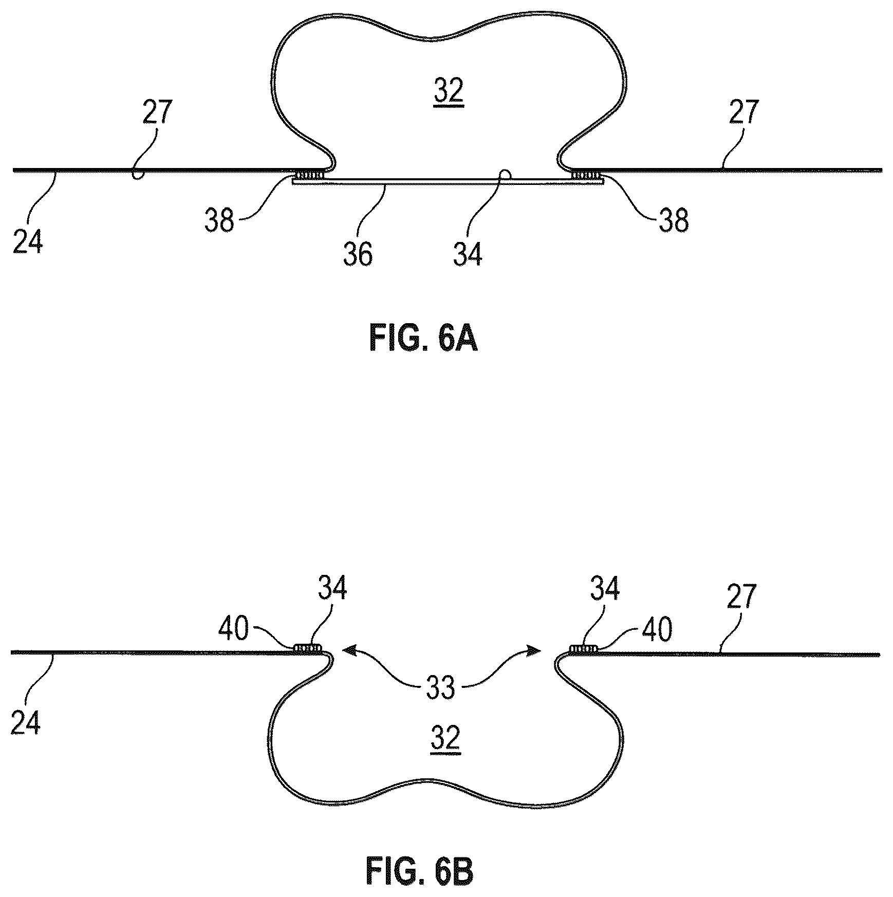 Patent US12350515 Figure 4 – Variable volume brachytherapy stent, method for delivering variable dosimetries in brachytherapy