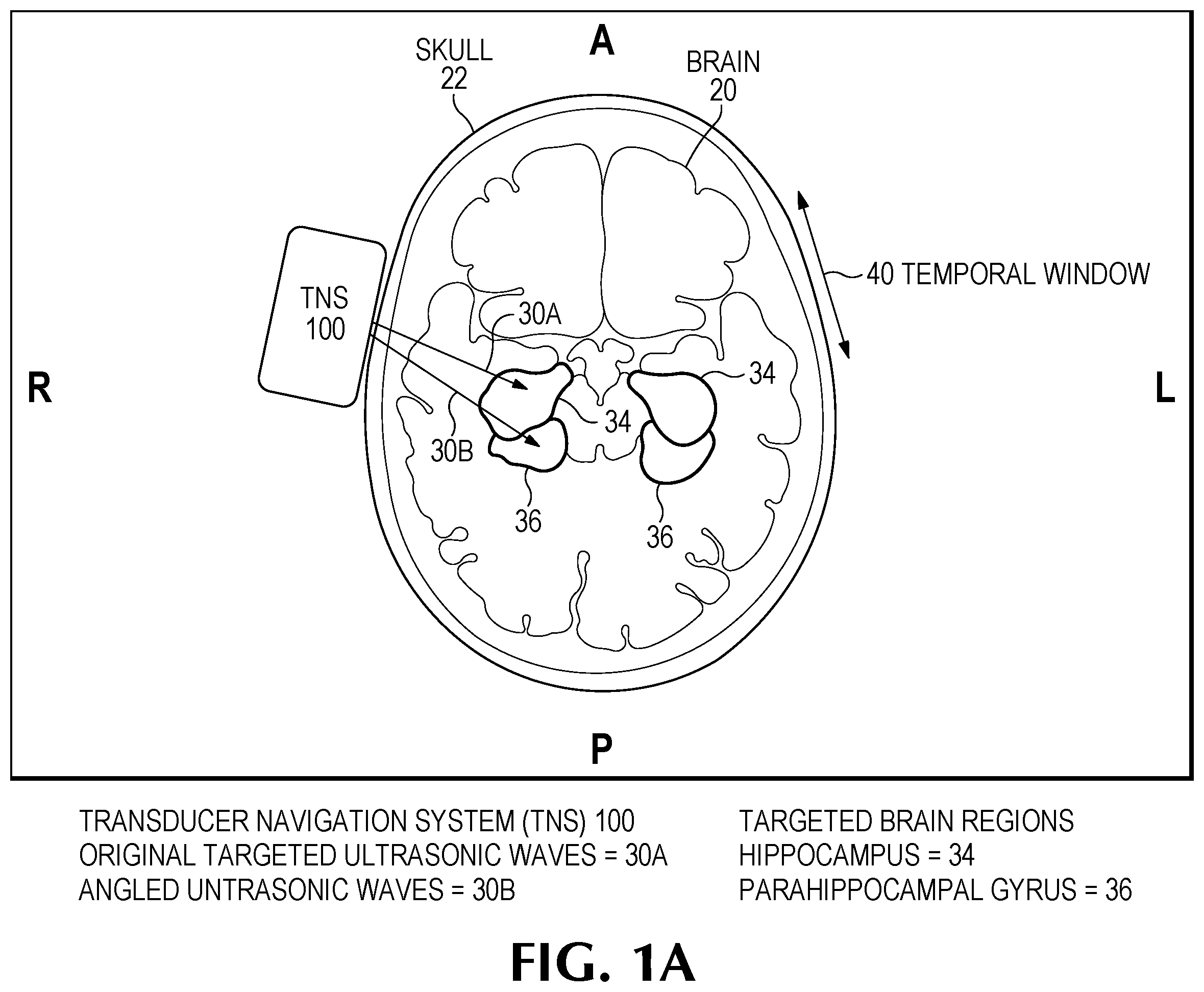 Patent US12350524 Figure 1 – Treating degenerative dementia with low intensity focused ultrasound pulsation (LIFUP) device