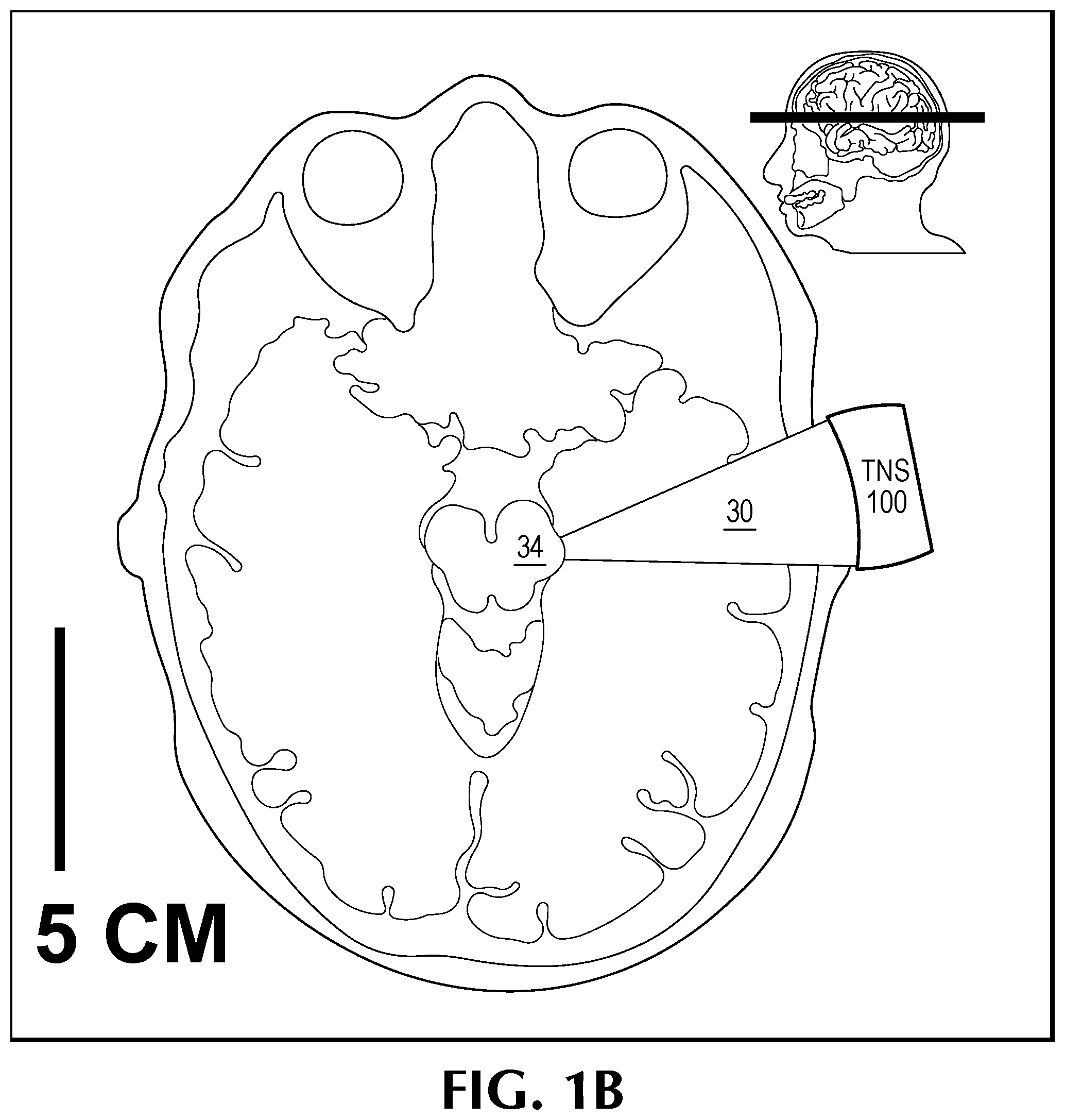 Patent US12350524 Figure 2 – Treating degenerative dementia with low intensity focused ultrasound pulsation (LIFUP) device