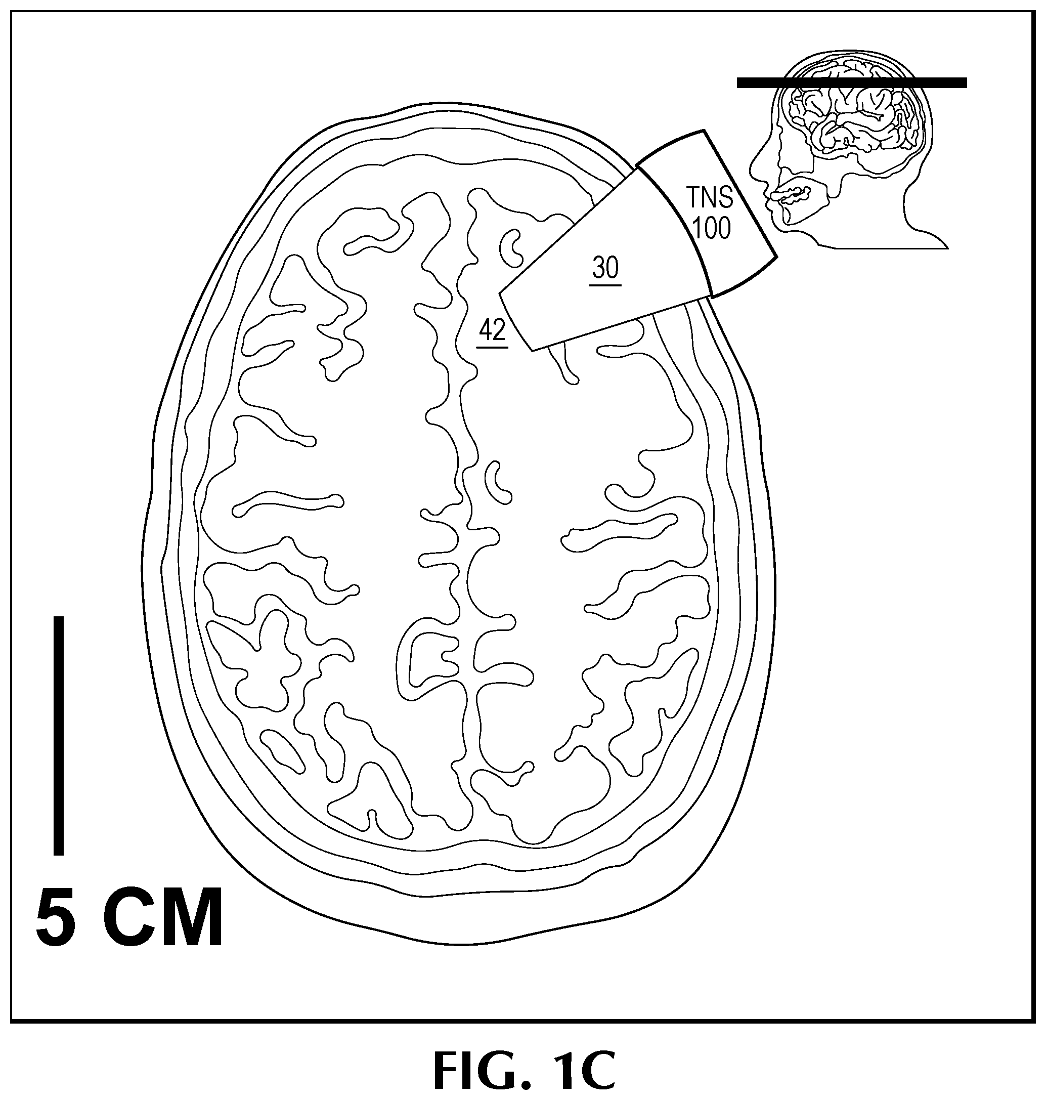 Patent US12350524 Figure 3 – Treating degenerative dementia with low intensity focused ultrasound pulsation (LIFUP) device