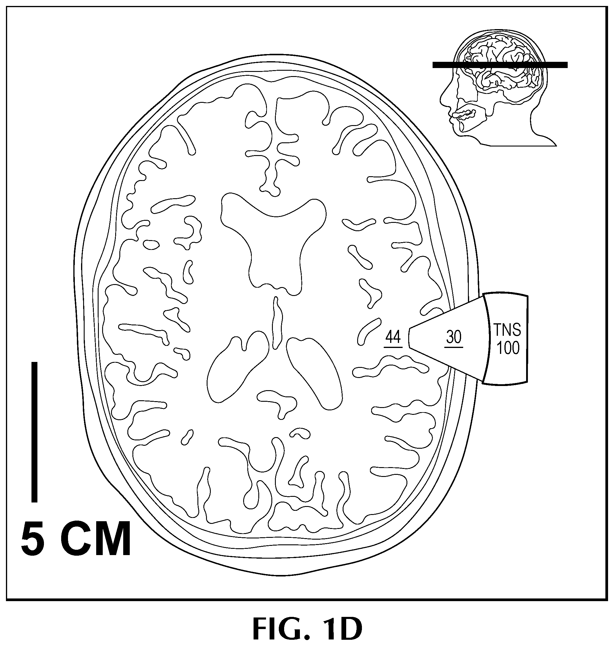 Patent US12350524 Figure 4 – Treating degenerative dementia with low intensity focused ultrasound pulsation (LIFUP) device
