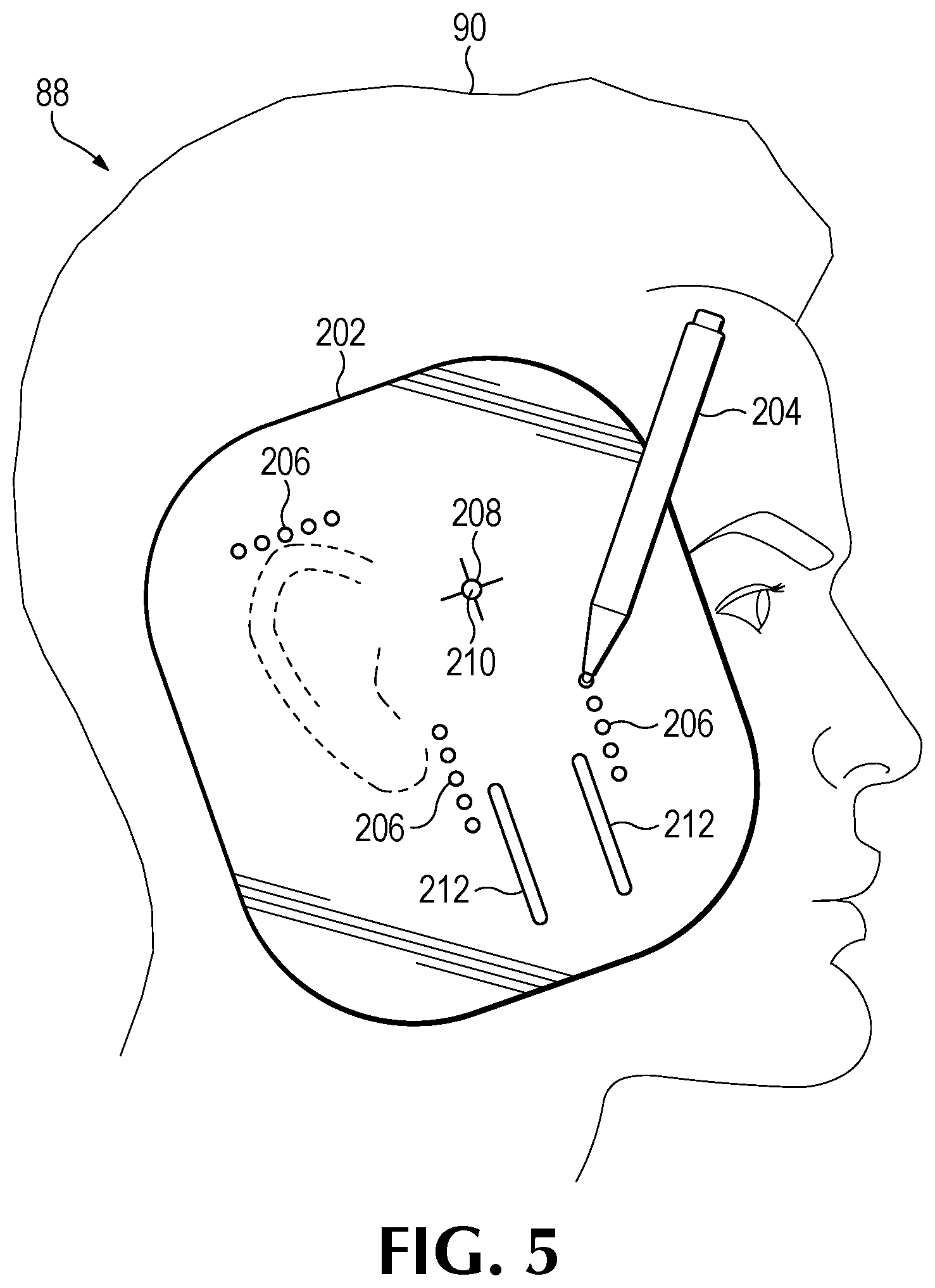Patent US12350524 Figure 12 – Treating degenerative dementia with low intensity focused ultrasound pulsation (LIFUP) device