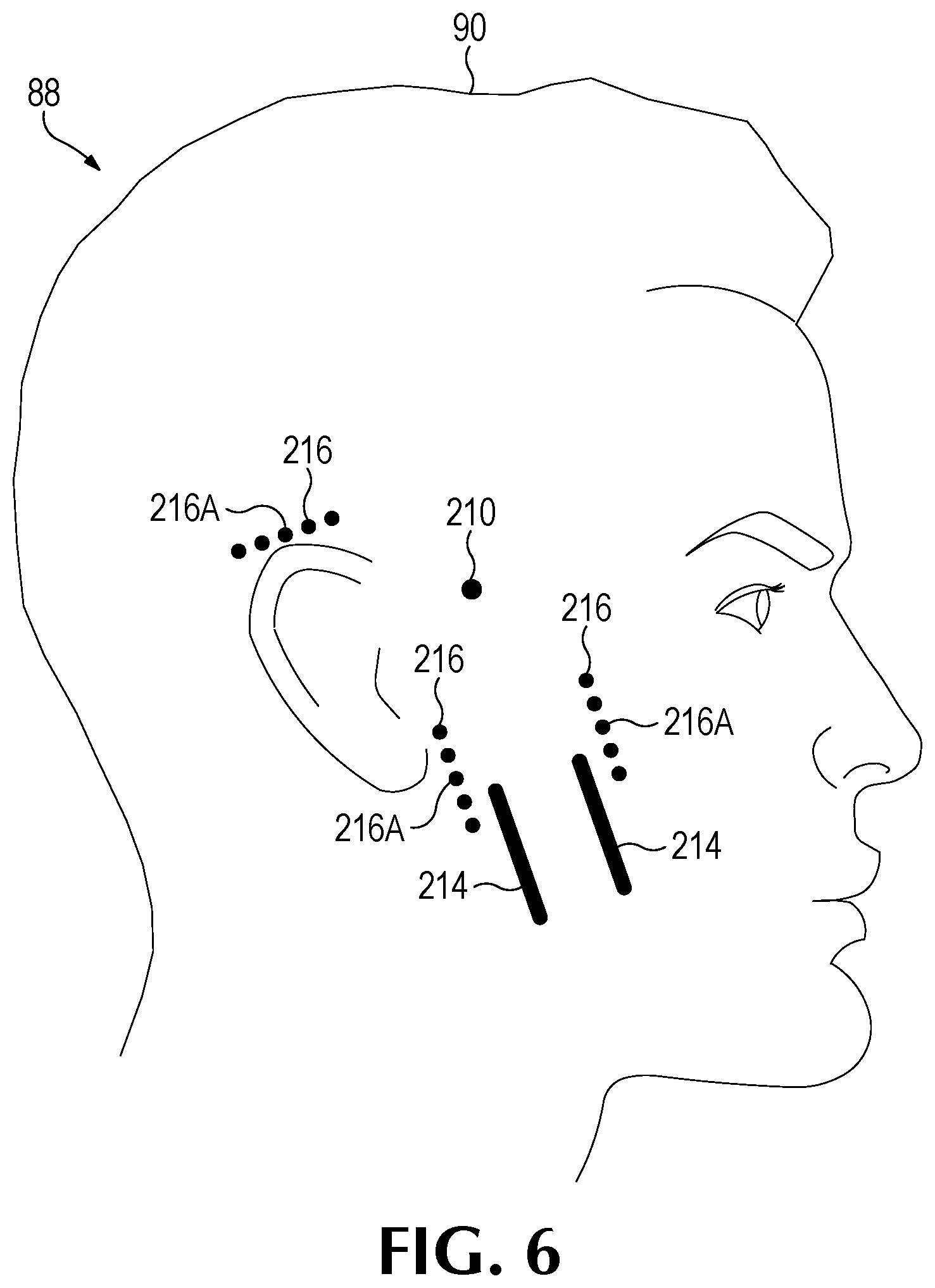 Patent US12350524 Figure 13 – Treating degenerative dementia with low intensity focused ultrasound pulsation (LIFUP) device