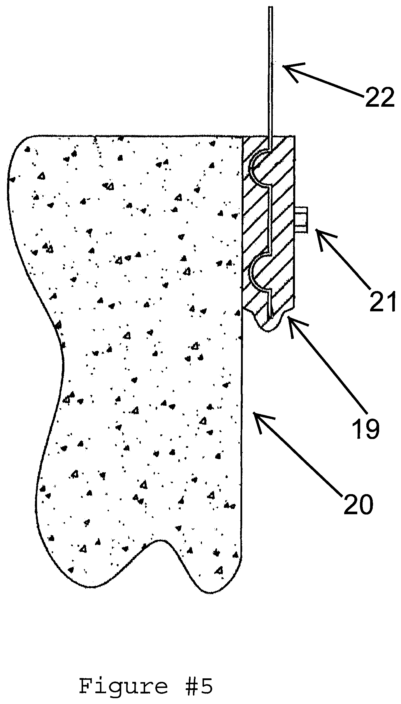 Patent US12359458 Figure 6 – Apparatus for unifying structural continuous load paths and reinforcing a roofing structural system utilizing super high tensile strength tape and plastic attachment mechanisms