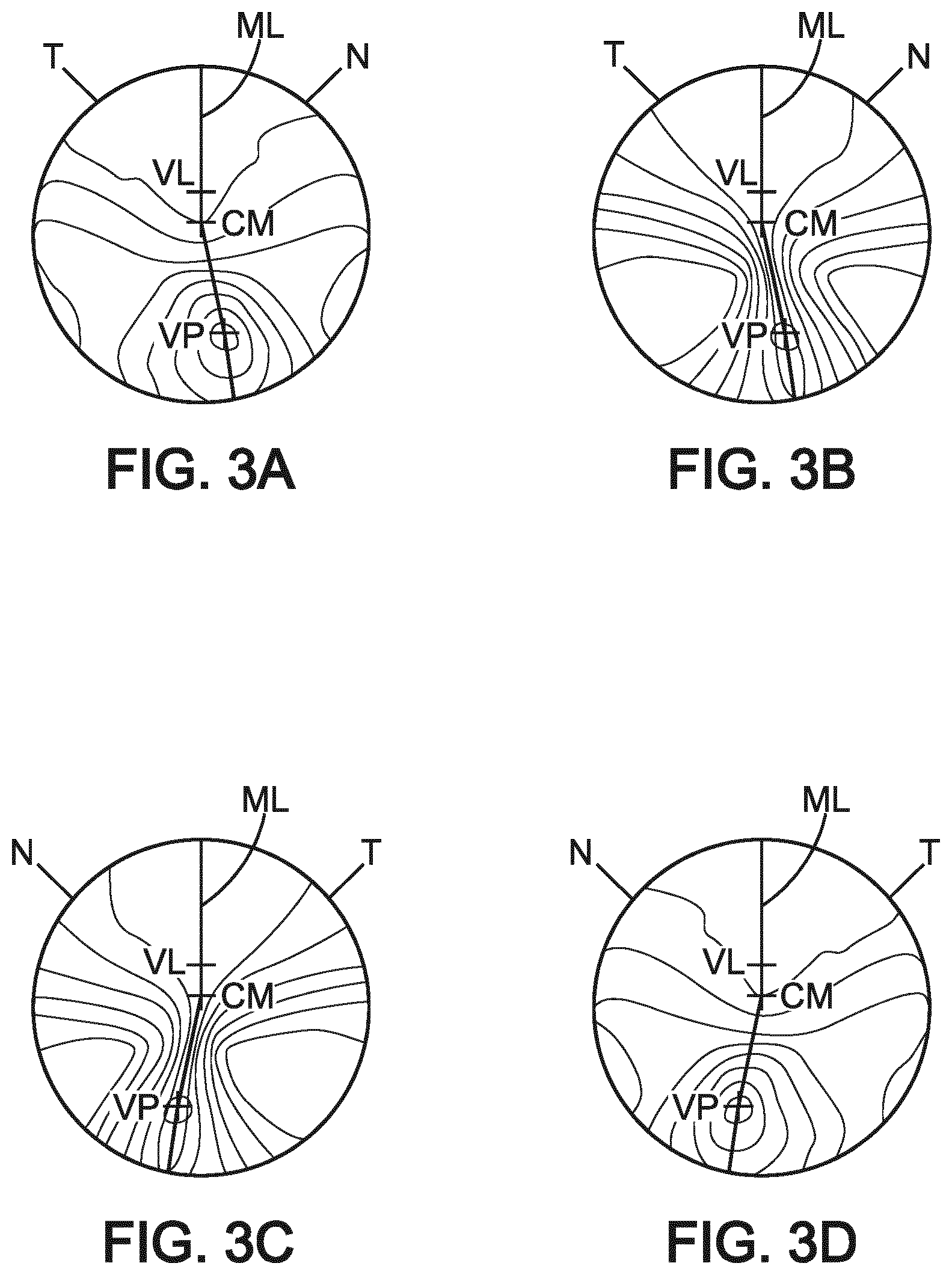 Patent US12360400 Figure 3 – Method for determining a progressive lens and associated system