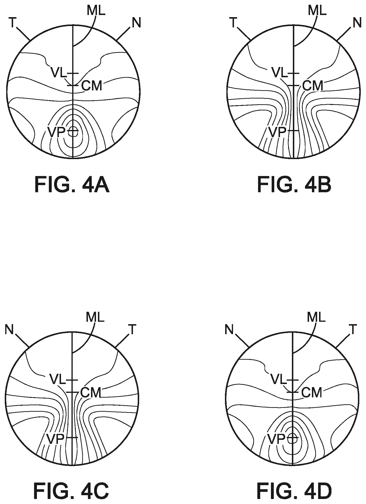 Patent US12360400 Figure 4 – Method for determining a progressive lens and associated system