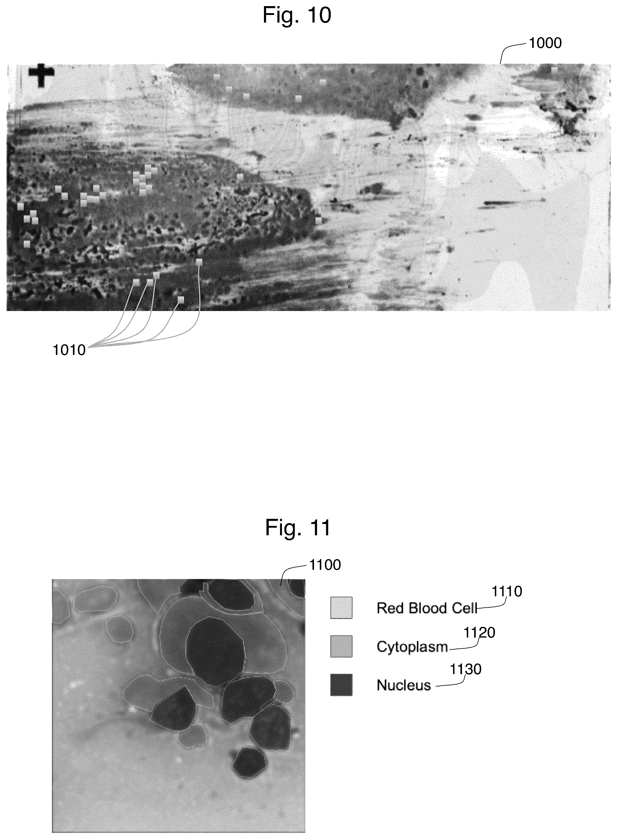 Patent US12361545 Figure 11 – Rapid on-site evaluation using artificial intelligence for lung cytopathology