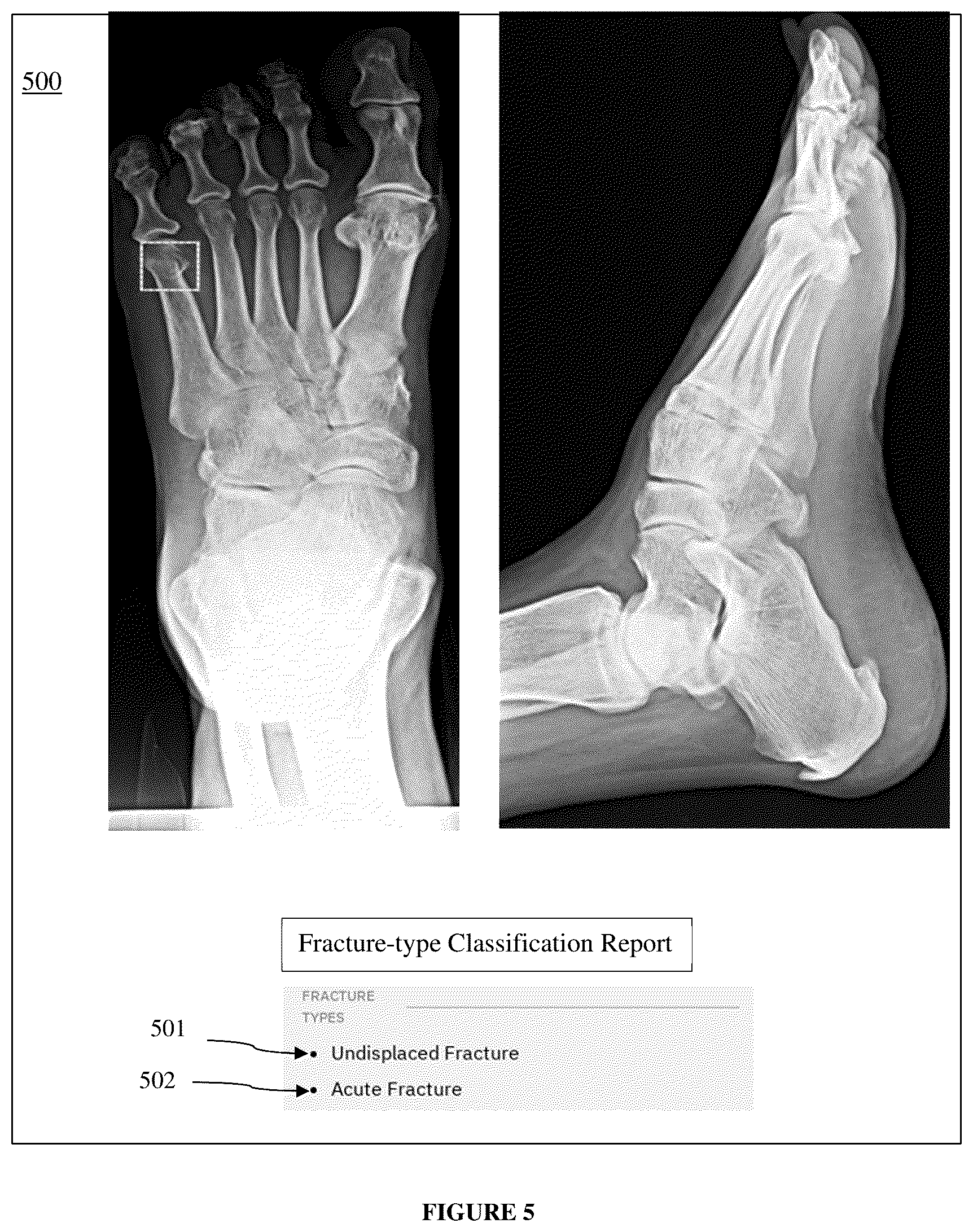 Patent US12361555 Figure 5 – System and method for classifying type of a fracture on musculoskeletal X-ray image