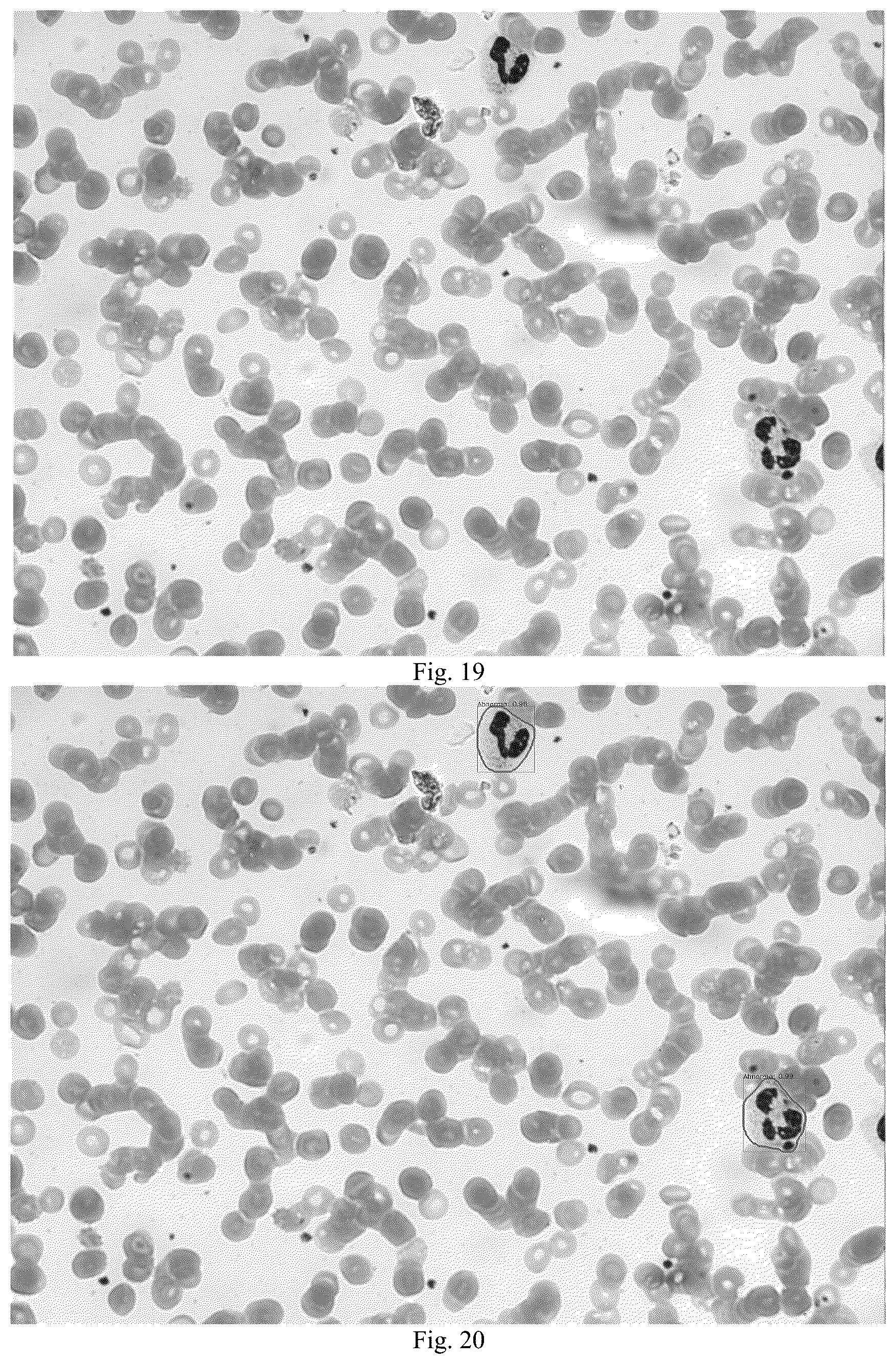Patent US12361560 Figure 13 – Blood smear full-view intelligent analysis method, and blood cell segmentation model and recognition model construction method