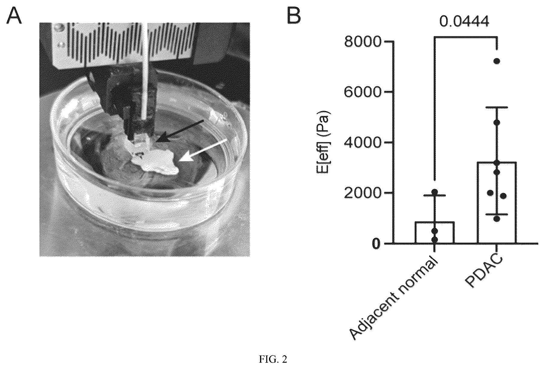 Patent US12365901 Figure 2 – Application of mechanical-force sensitive macrophage subset in pancreatic cancer diagnosis or prognosis evaluation
