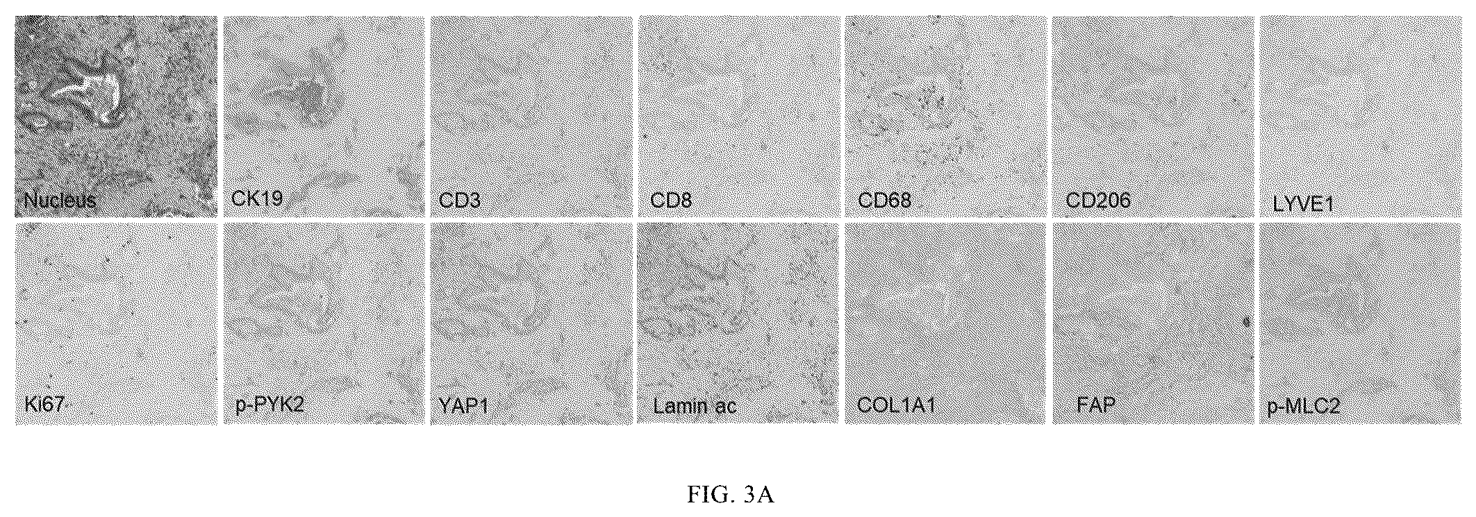 Patent US12365901 Figure 3 – Application of mechanical-force sensitive macrophage subset in pancreatic cancer diagnosis or prognosis evaluation