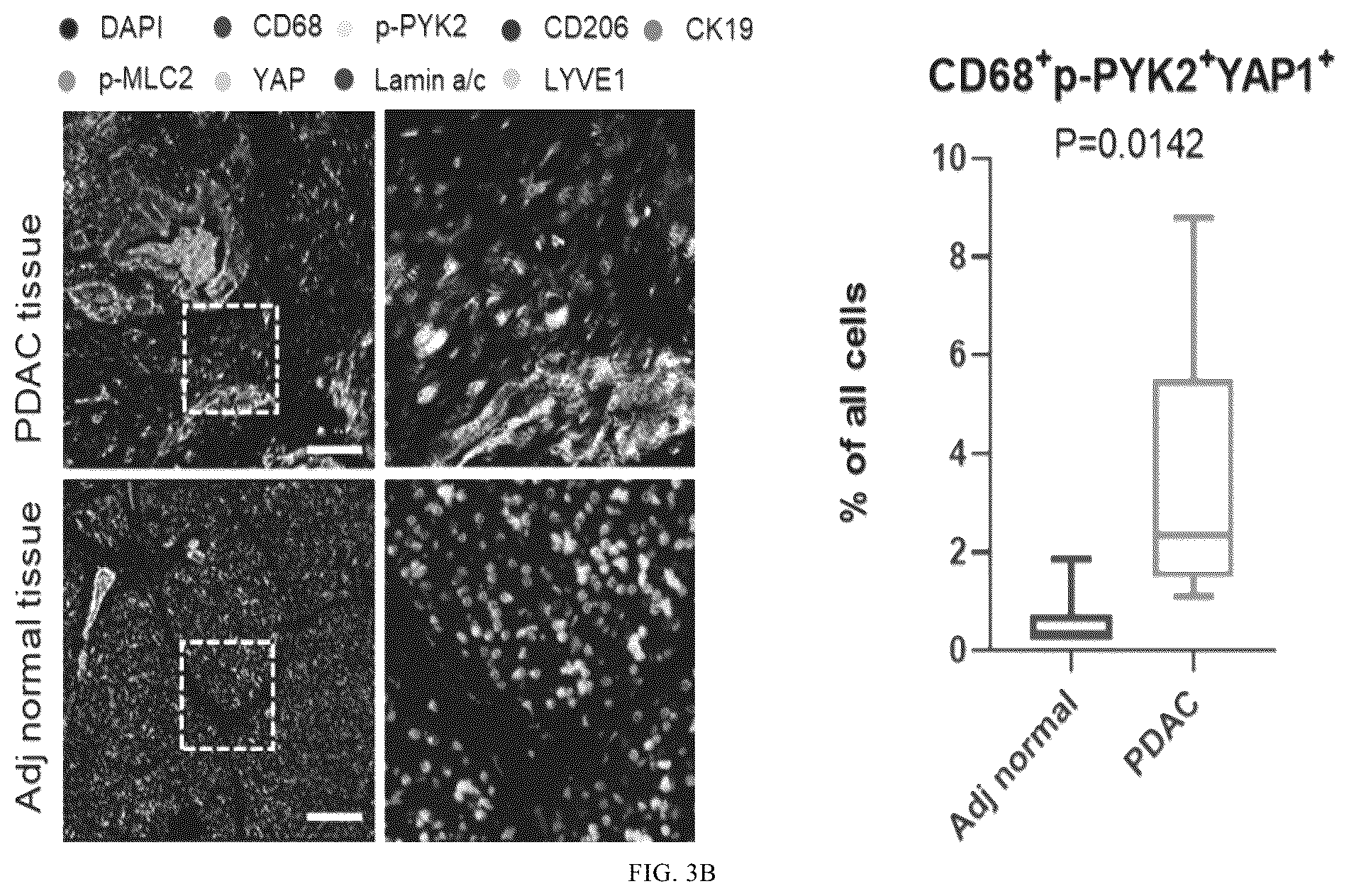 Patent US12365901 Figure 4 – Application of mechanical-force sensitive macrophage subset in pancreatic cancer diagnosis or prognosis evaluation