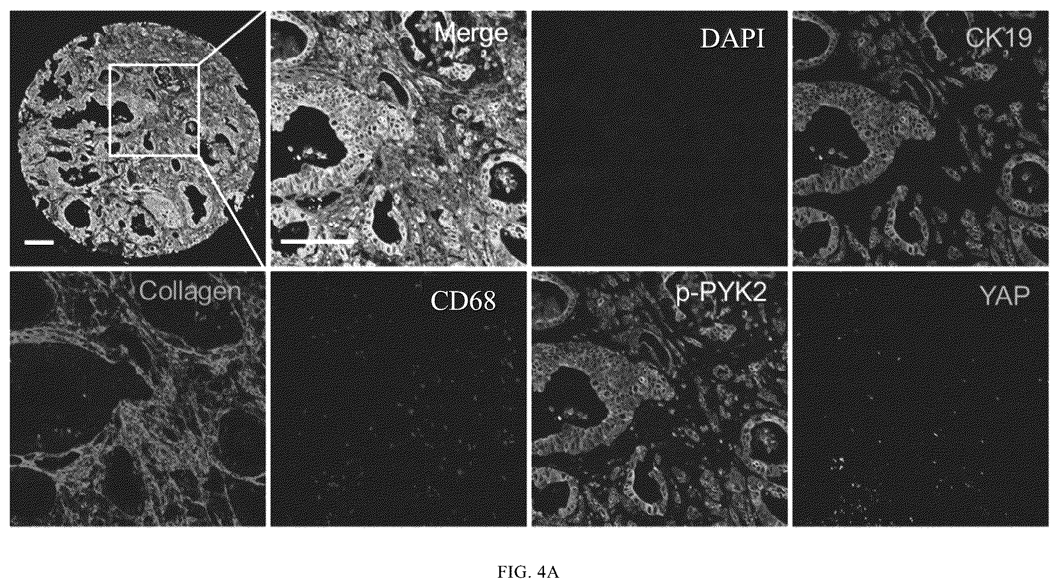 Patent US12365901 Figure 6 – Application of mechanical-force sensitive macrophage subset in pancreatic cancer diagnosis or prognosis evaluation
