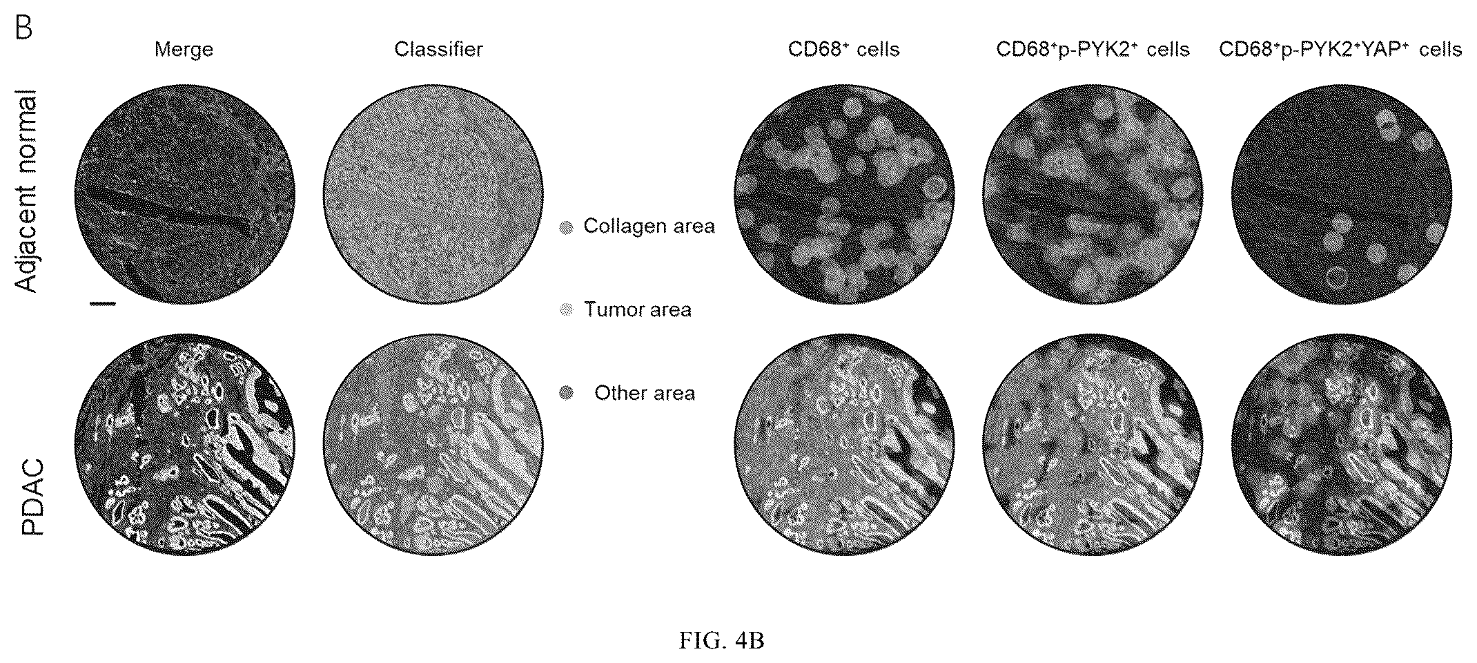 Patent US12365901 Figure 7 – Application of mechanical-force sensitive macrophage subset in pancreatic cancer diagnosis or prognosis evaluation