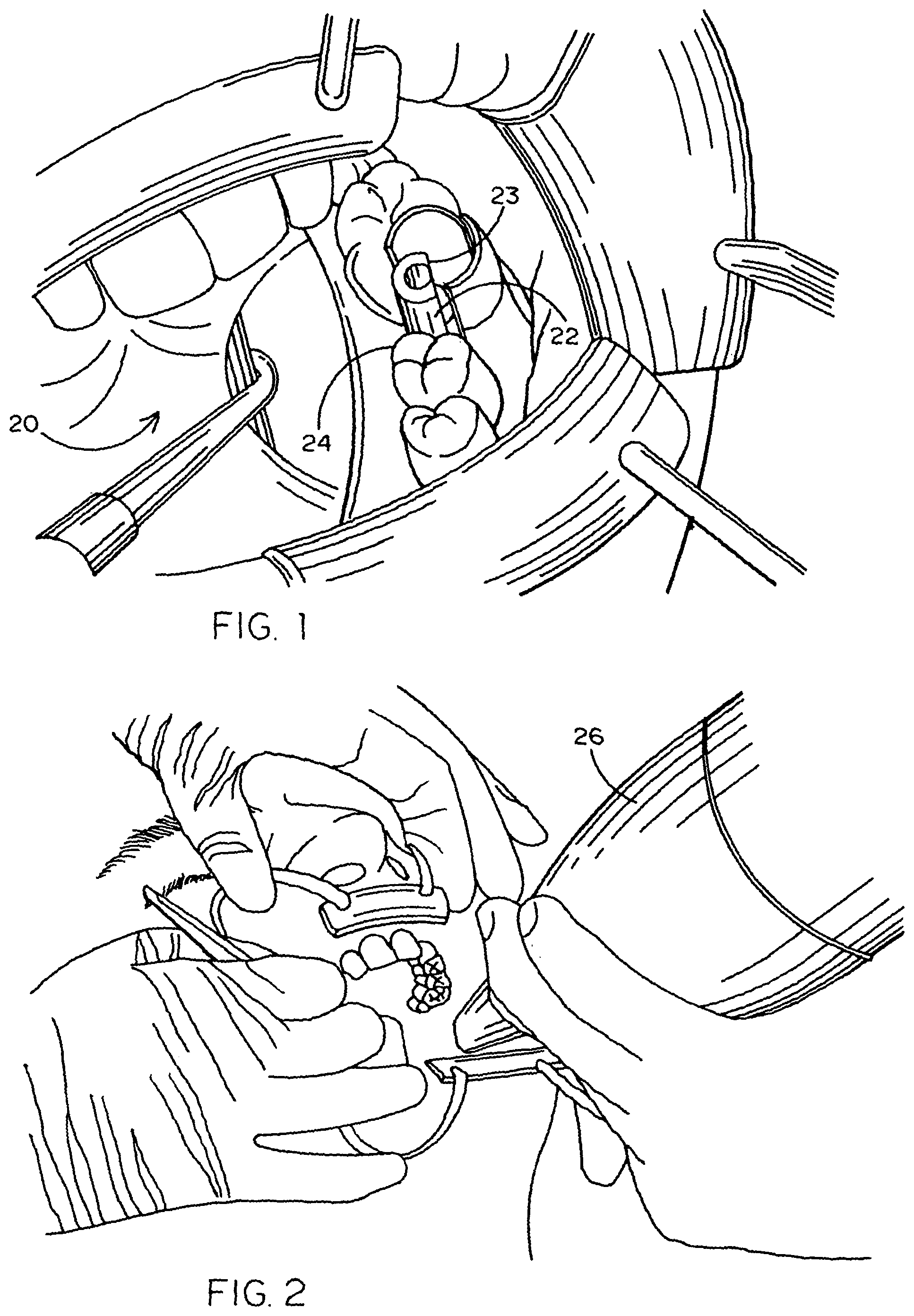 Patent US12367580 Figure 1 – Method of designing and fabricating patient-specific restorations from intra-oral scanning of a digital impression coping
