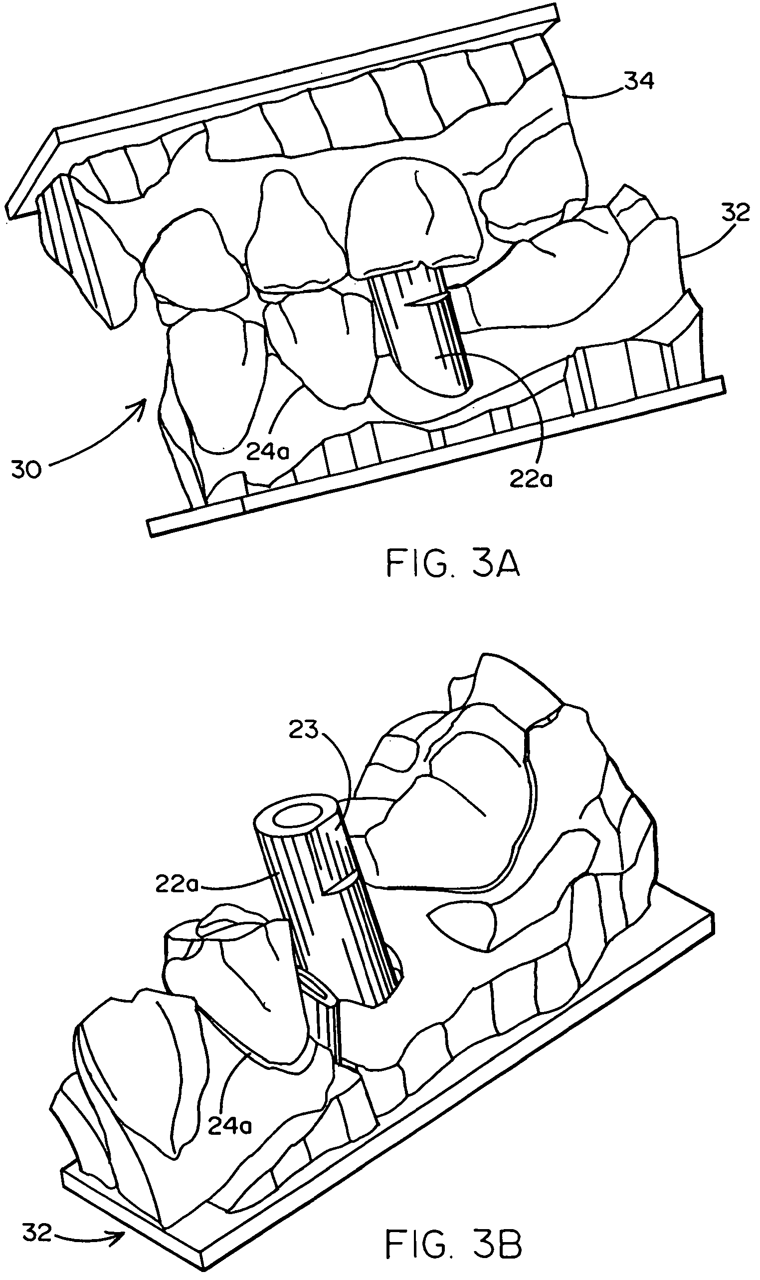 Patent US12367580 Figure 2 – Method of designing and fabricating patient-specific restorations from intra-oral scanning of a digital impression coping