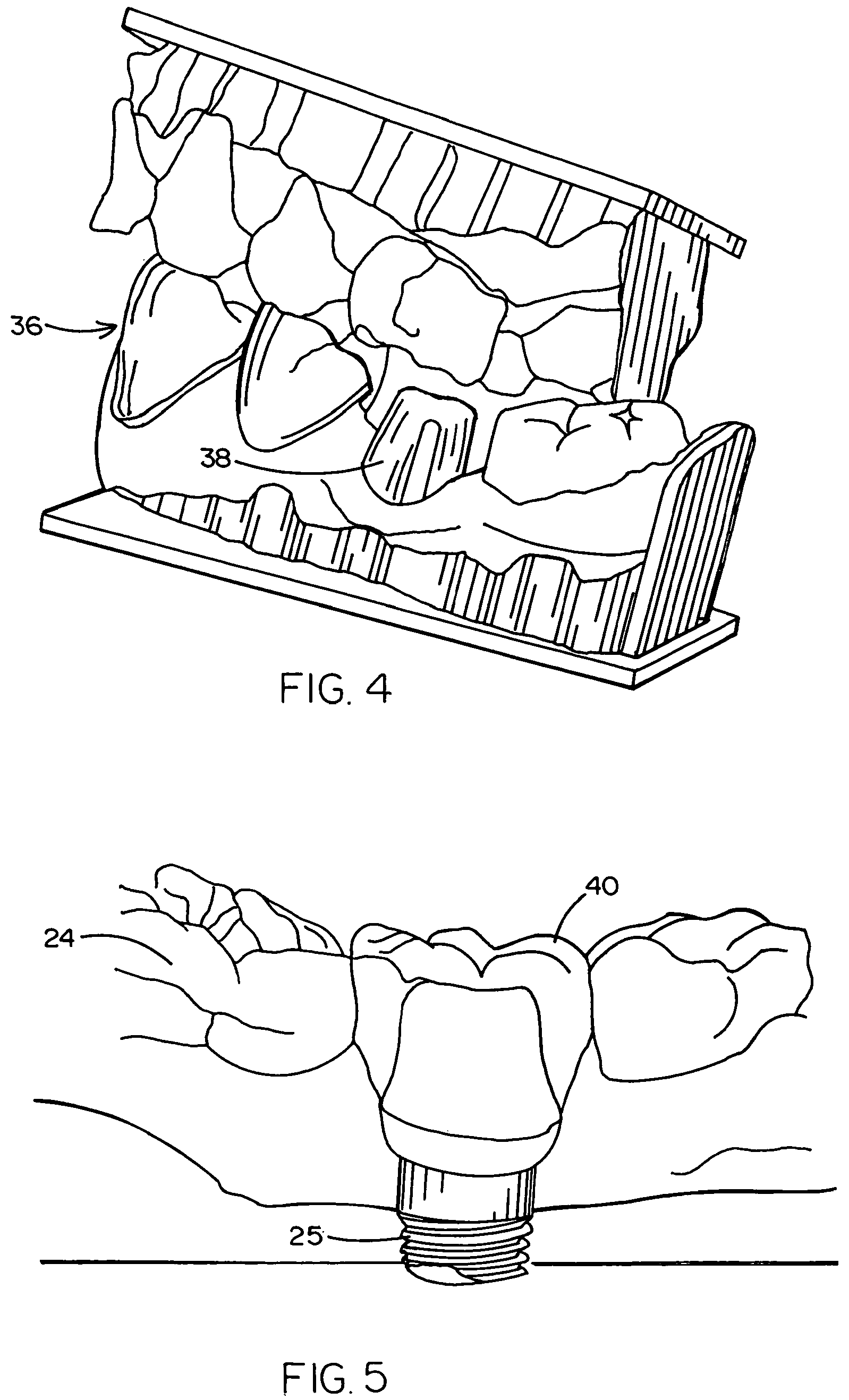 Patent US12367580 Figure 3 – Method of designing and fabricating patient-specific restorations from intra-oral scanning of a digital impression coping