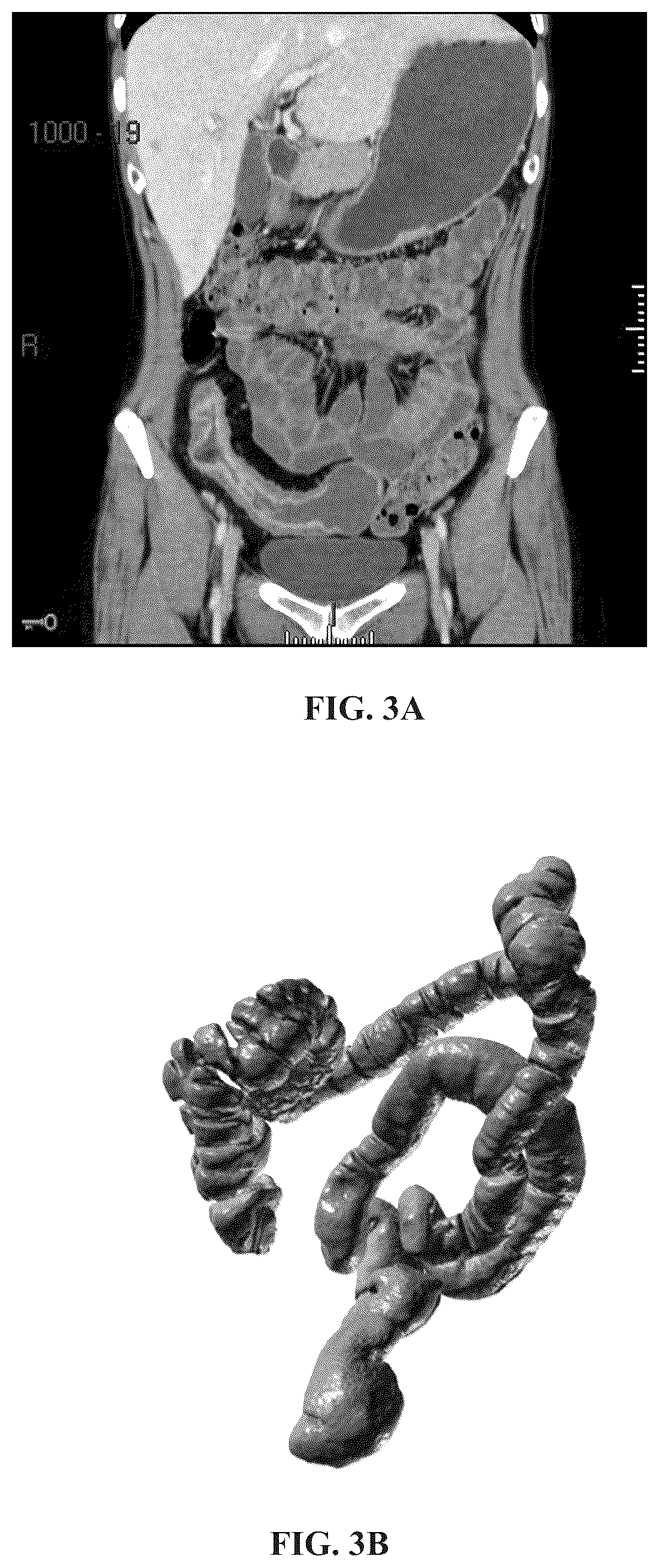 Patent US12367589 Figure 2 – Method and terminal for detecting protrusion in intestinal tract, and computer-readable storage medium