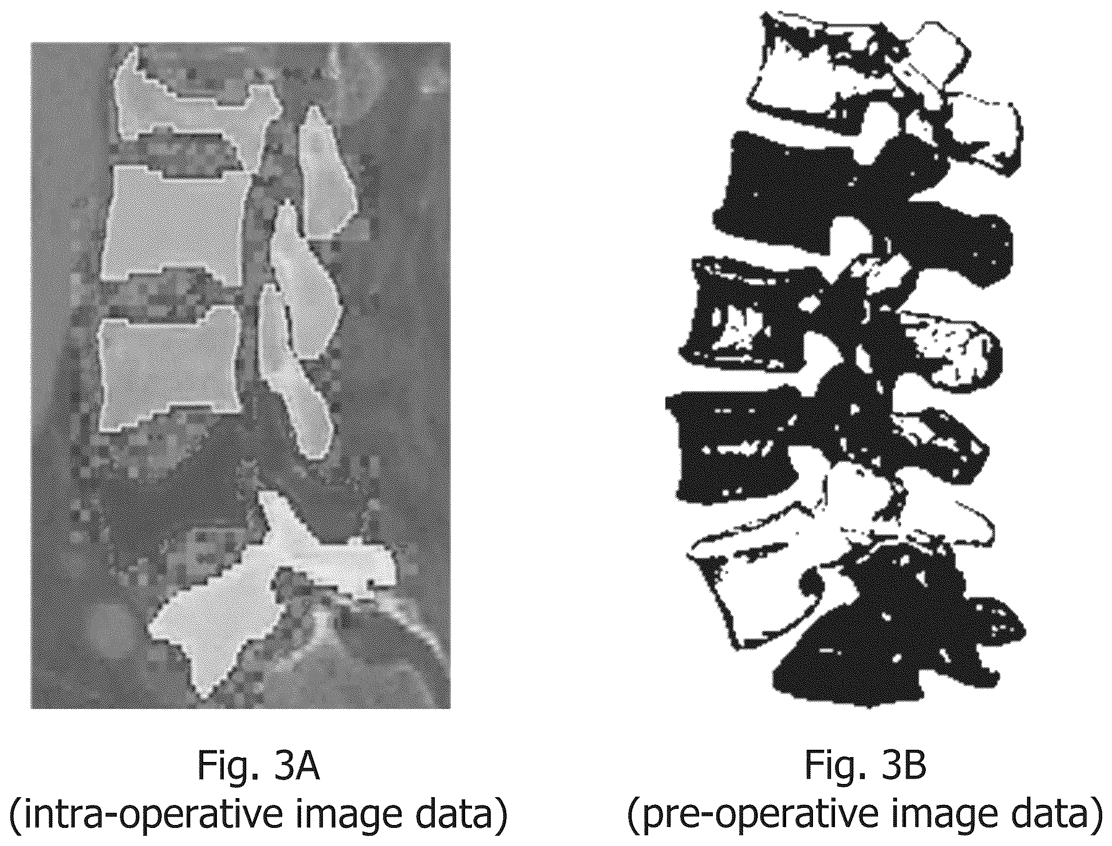Patent US12367598 Figure 3 – Technique of generating surgical information from intra-operatively and pre-operatively acquired image data