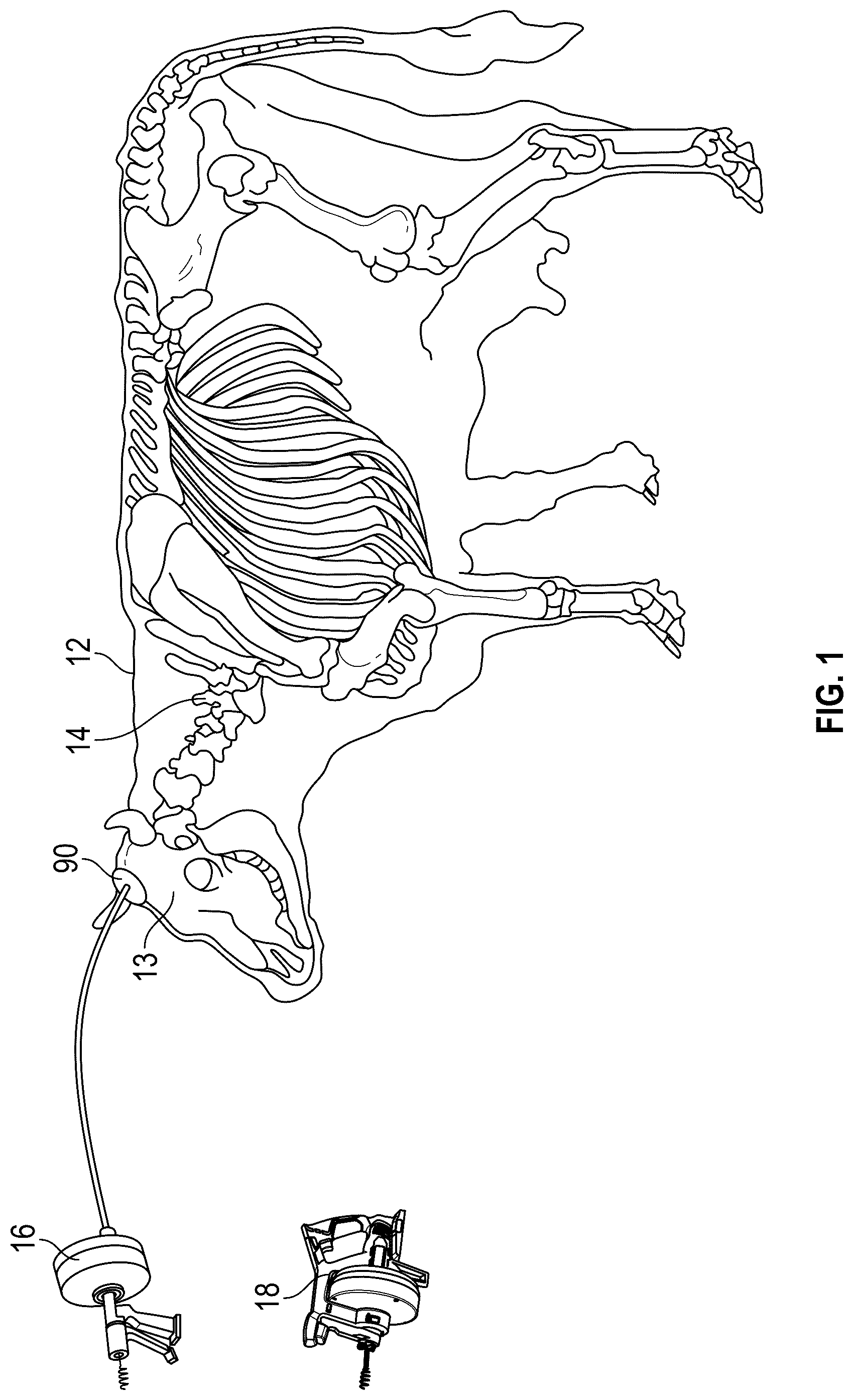 Patent US12376598 Figure 1 – Brain and spinal cord removal device and related methods