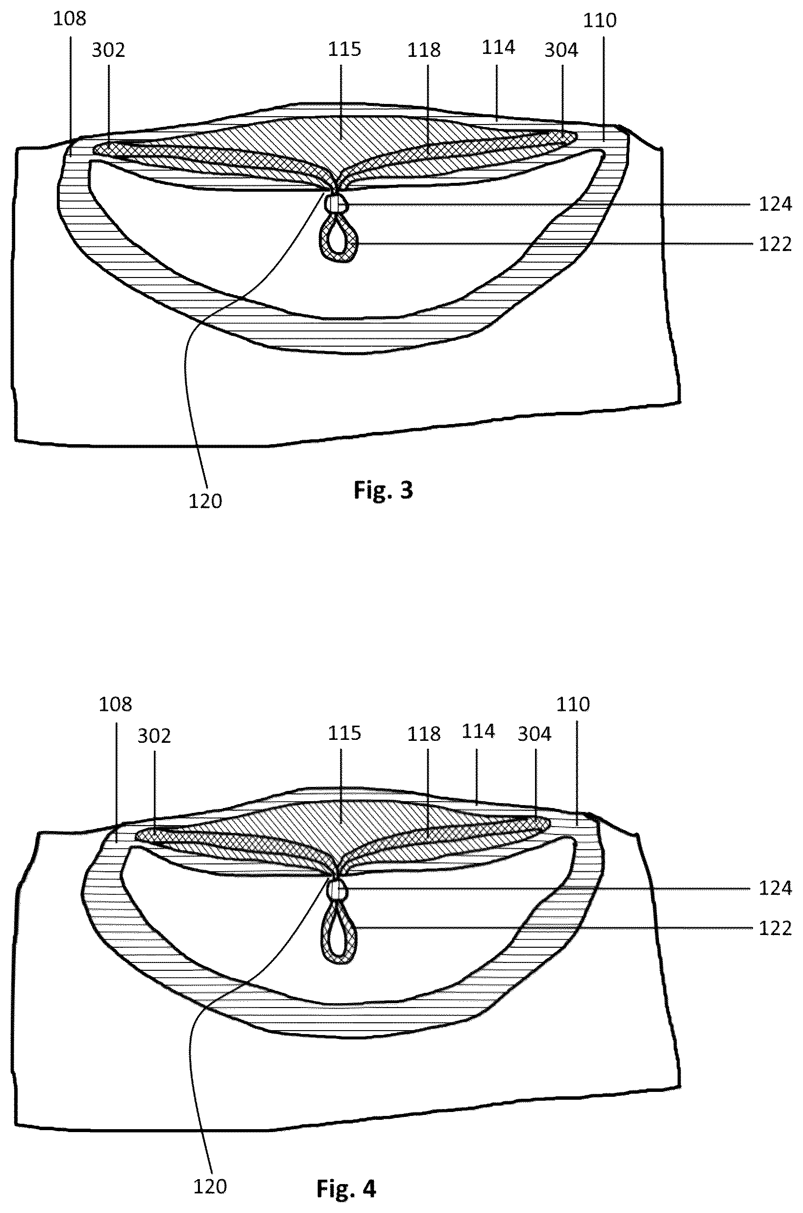 Patent US12376627 Figure 2 – Neckline fitting system