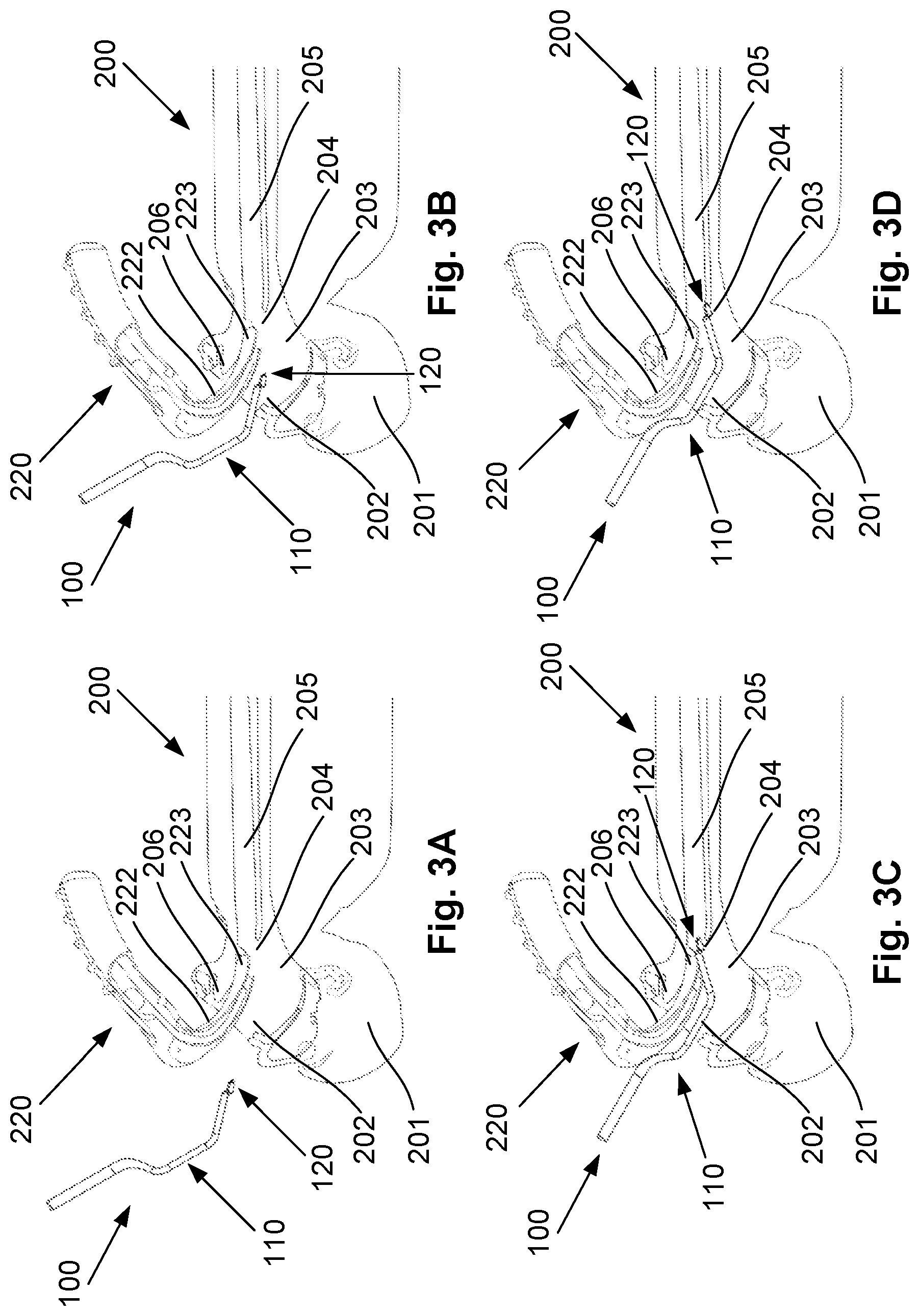 Patent US12376740 Figure 4 – Airway manipulator devices