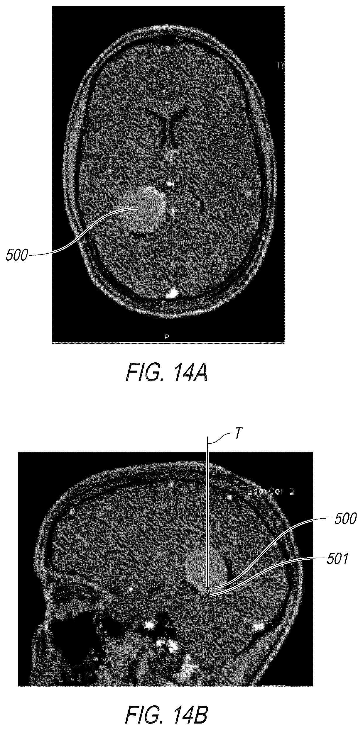 Patent US12376741 Figure 17 – Surgical access assembly and method of using same
