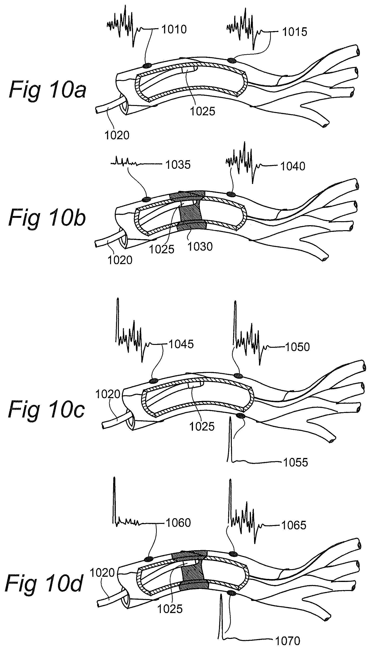 Patent US12376757 Figure 4 – Controlled sympathectomy and micro-ablation systems and methods