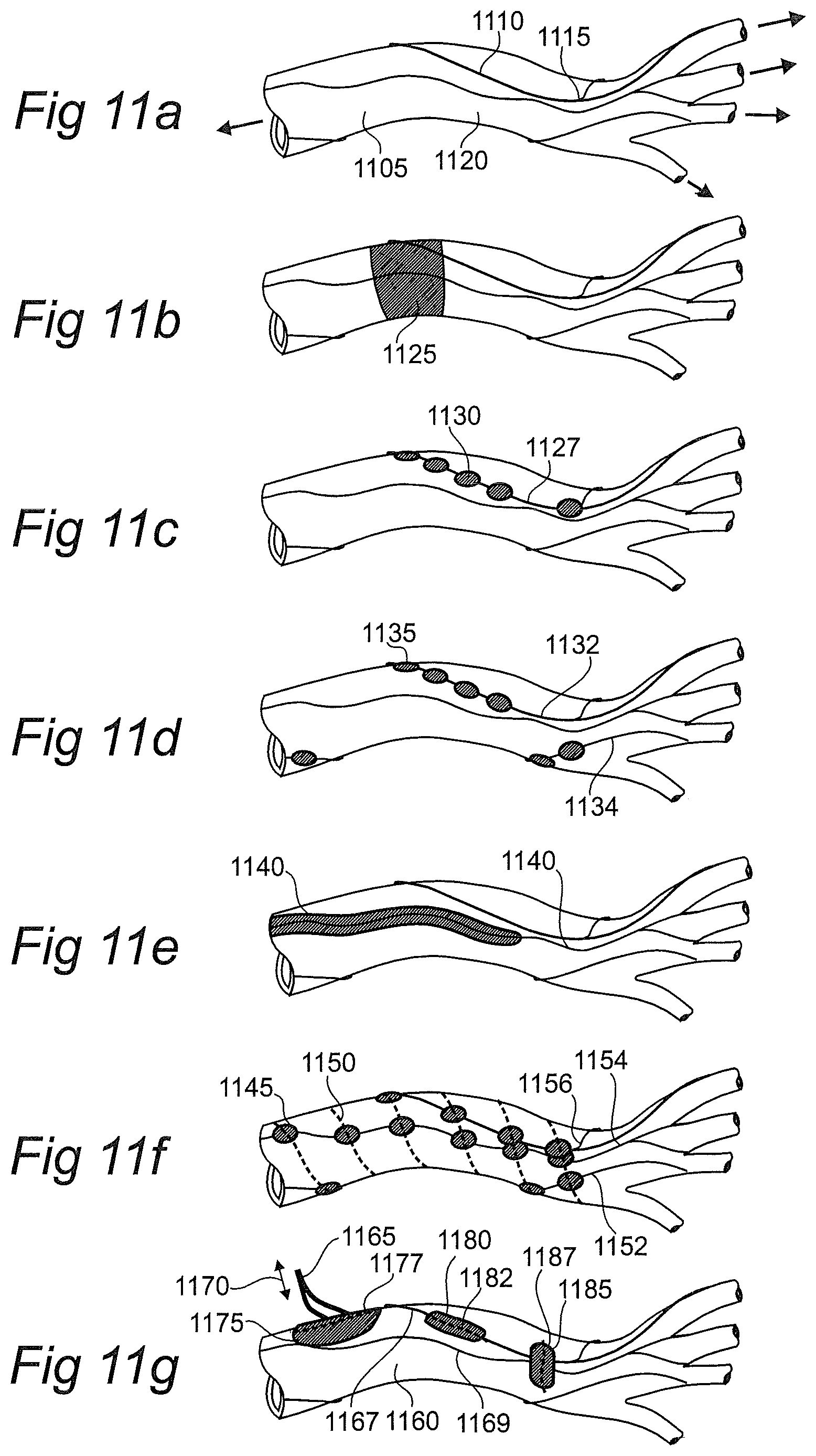 Patent US12376757 Figure 5 – Controlled sympathectomy and micro-ablation systems and methods