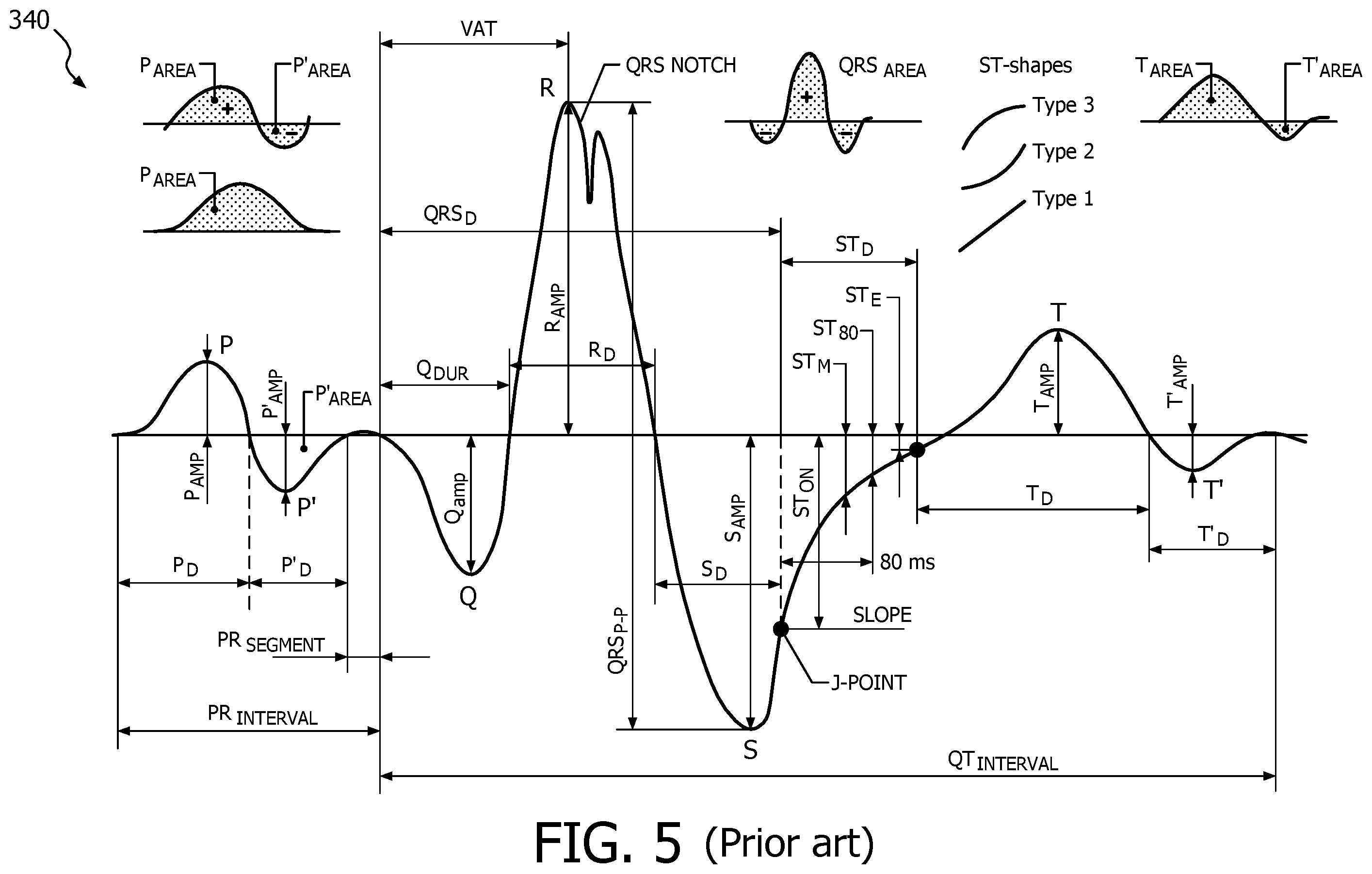 Patent US12376778 Figure 5 – ECG features for type ahead editing and automatic update for report interpretation