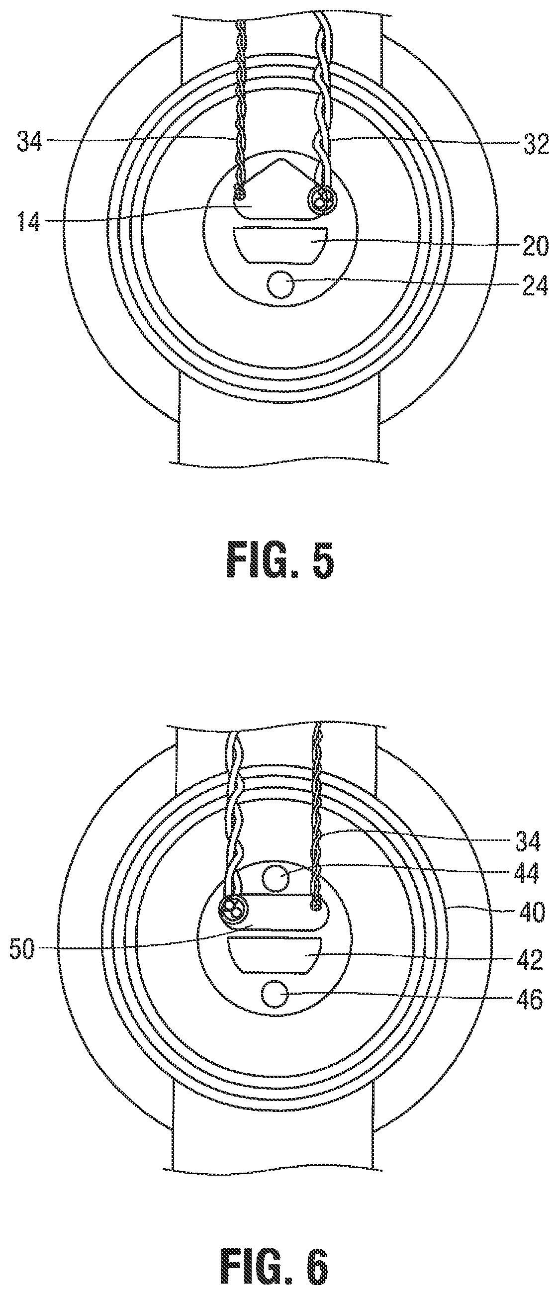 Patent US12376785 Figure 4 – Catheter for monitoring intra-abdominal pressure for assessing preeclampsia