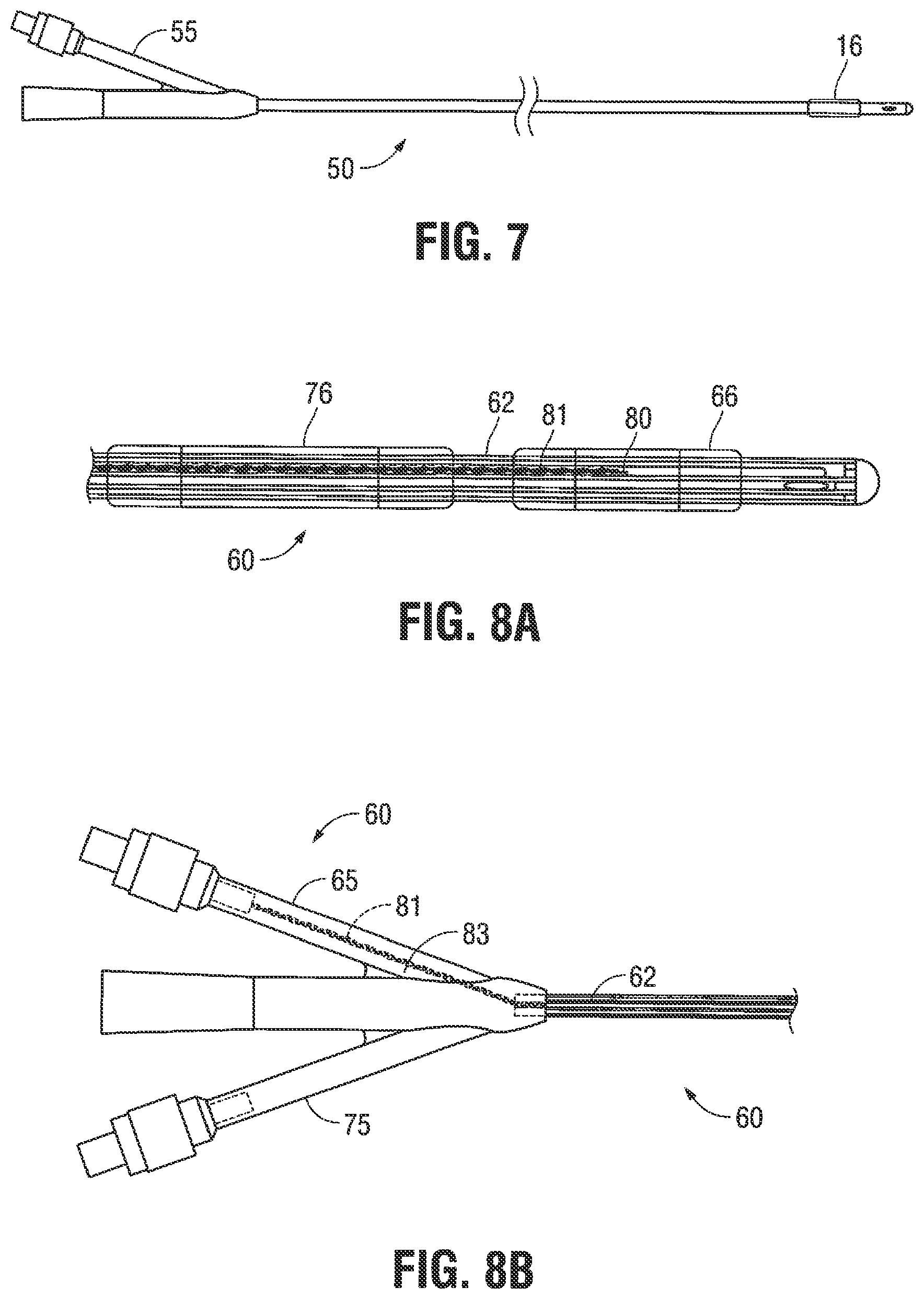 Patent US12376785 Figure 5 – Catheter for monitoring intra-abdominal pressure for assessing preeclampsia