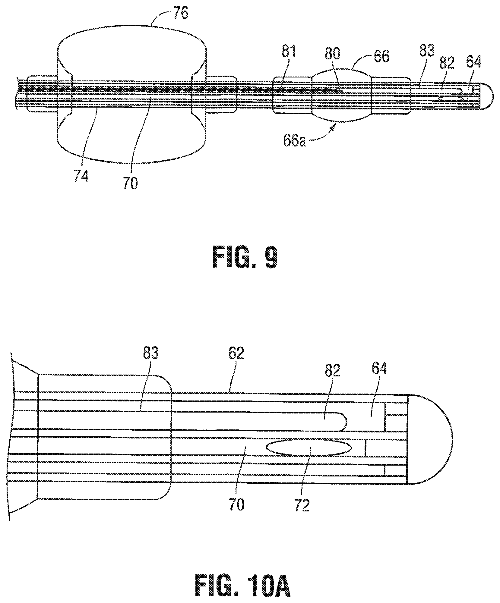 Patent US12376785 Figure 6 – Catheter for monitoring intra-abdominal pressure for assessing preeclampsia