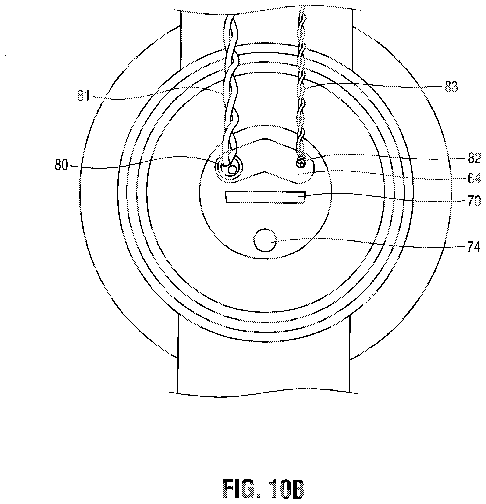 Patent US12376785 Figure 7 – Catheter for monitoring intra-abdominal pressure for assessing preeclampsia