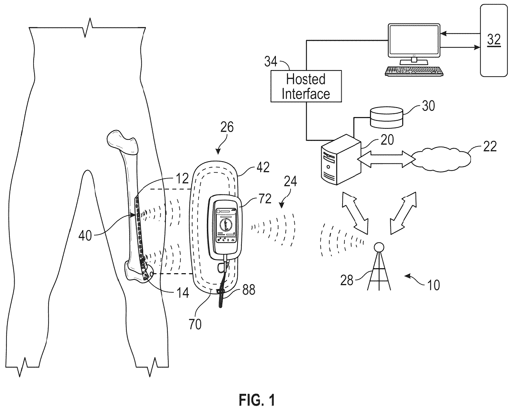 Patent US12376787 Figure 1 – Bone fixation monitoring system