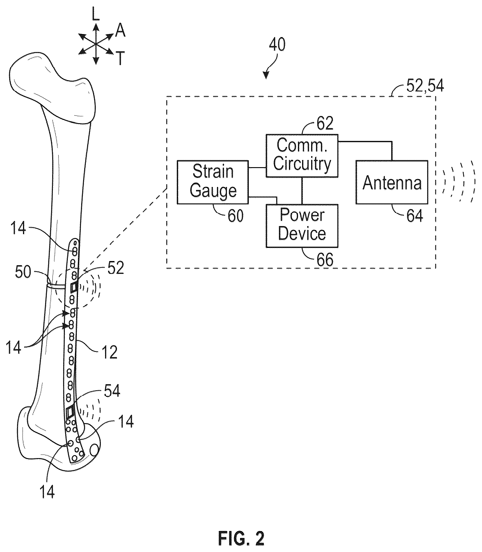 Patent US12376787 Figure 2 – Bone fixation monitoring system