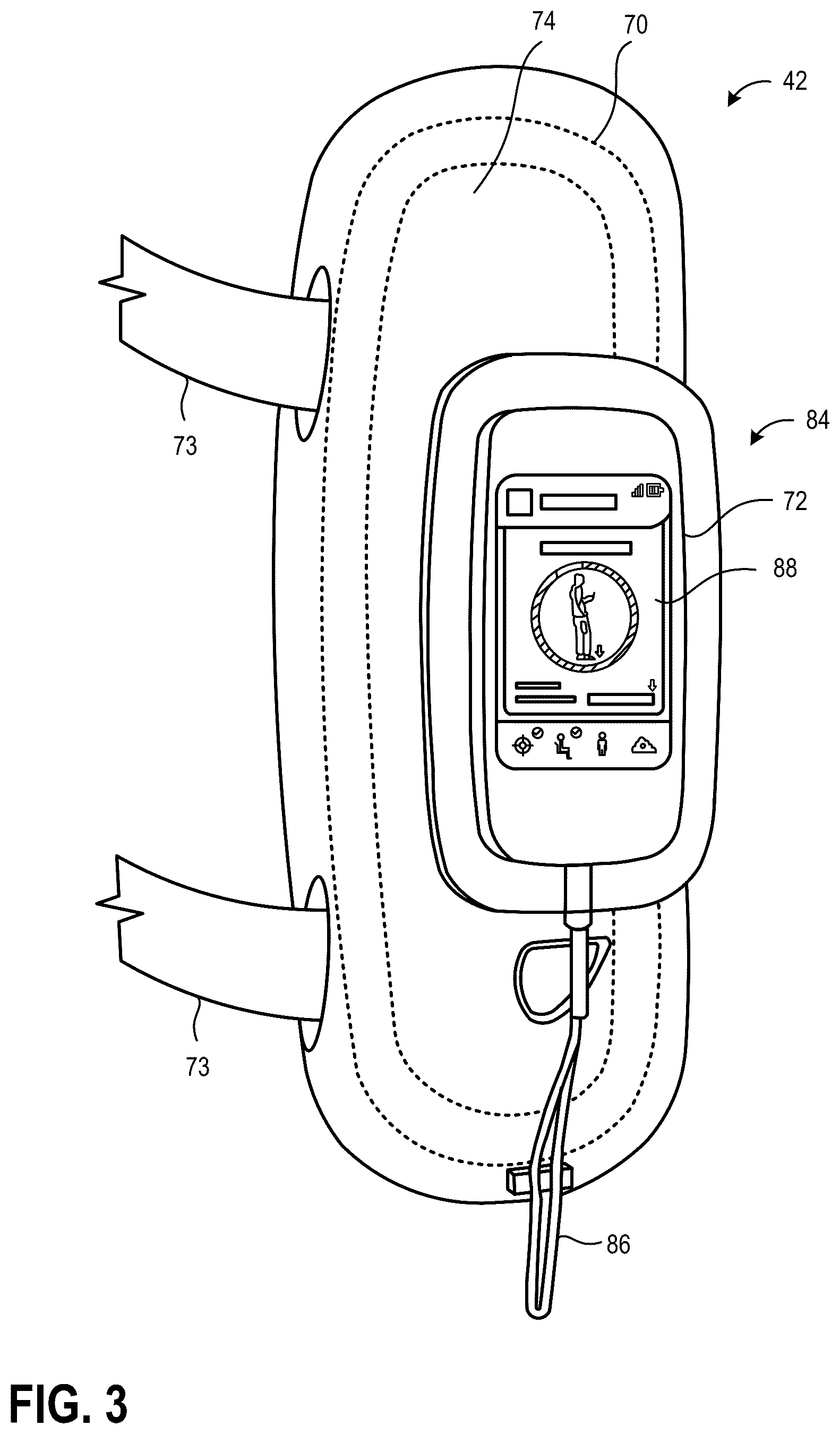 Patent US12376787 Figure 3 – Bone fixation monitoring system