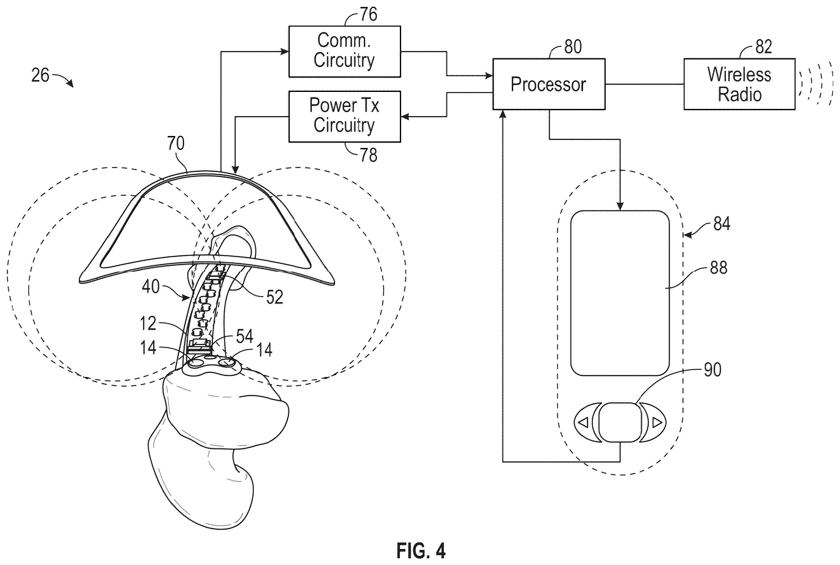 Patent US12376787 Figure 4 – Bone fixation monitoring system