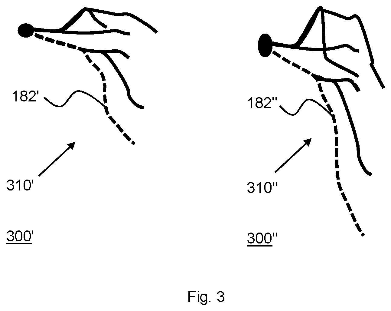 Patent US12376813 Figure 3 – Method and device for monitoring a flow of a fluid in a vessel
