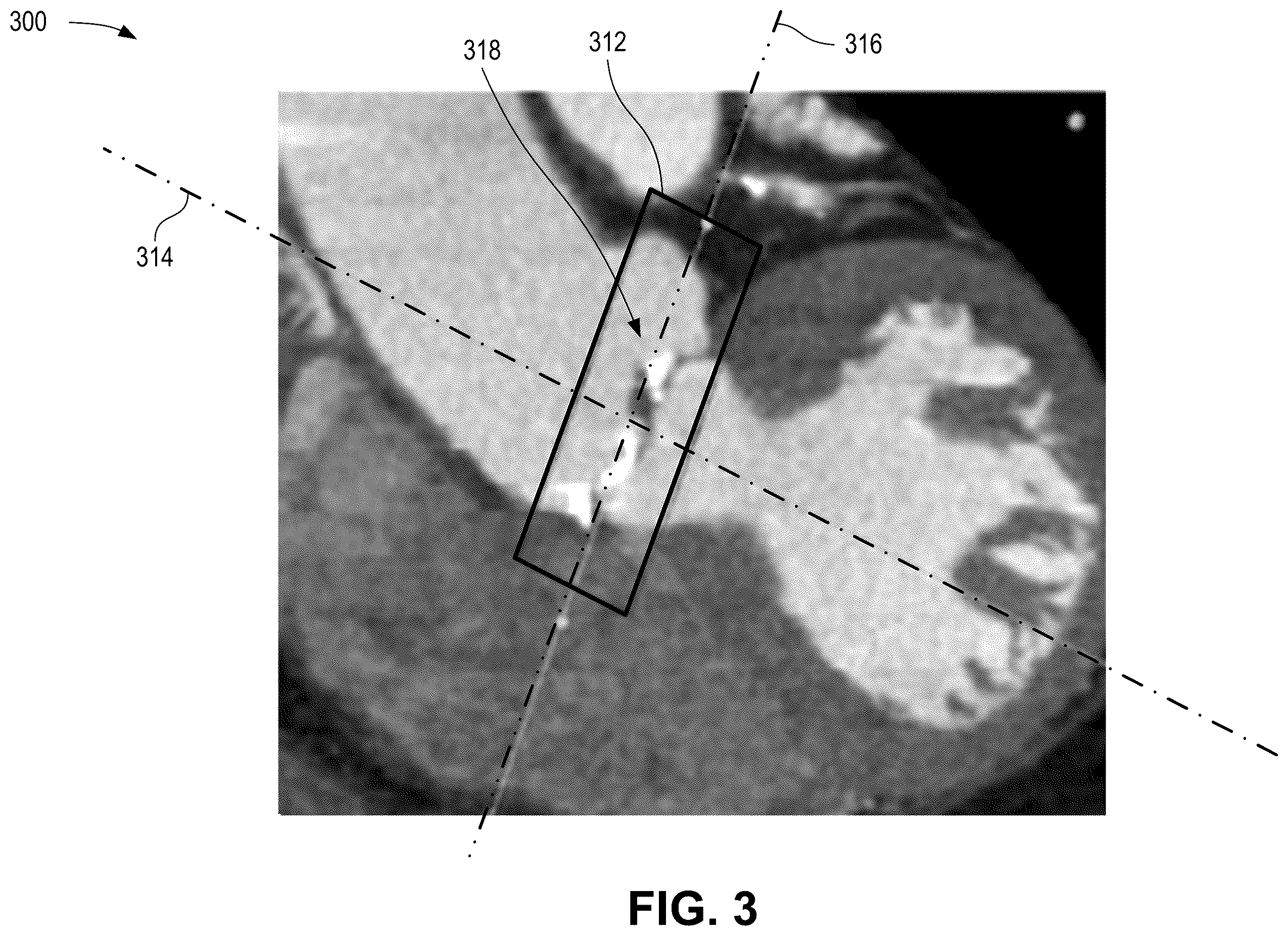 Patent US12376814 Figure 3 – Quantification of noncalcific and calcific valve tissue from coronary CT angiography