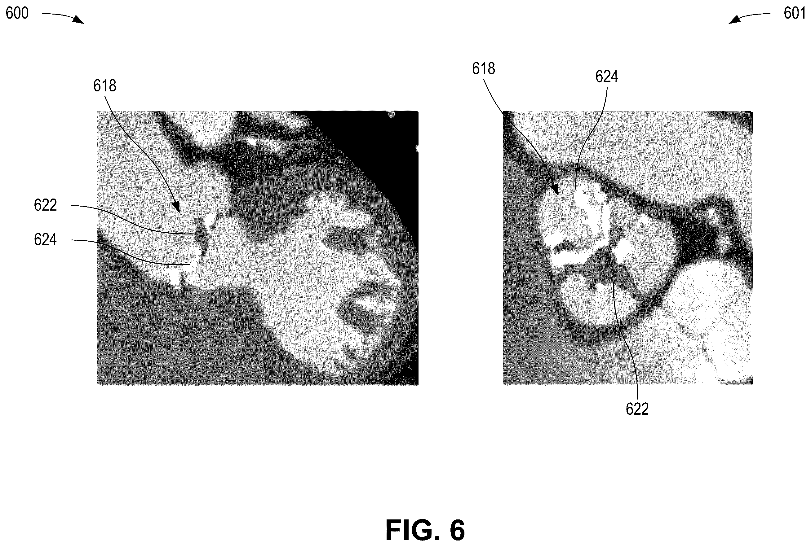 Patent US12376814 Figure 6 – Quantification of noncalcific and calcific valve tissue from coronary CT angiography