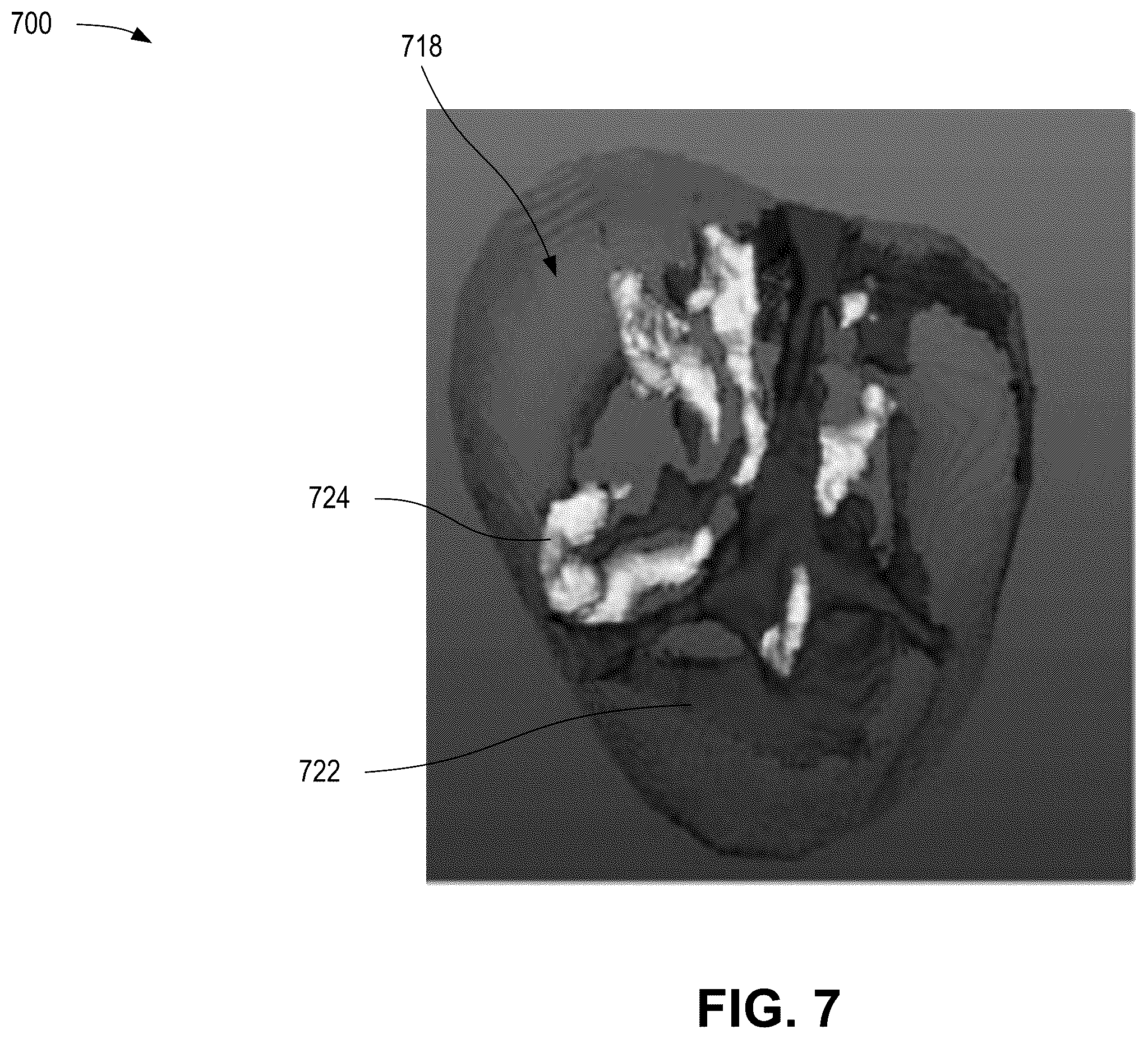 Patent US12376814 Figure 7 – Quantification of noncalcific and calcific valve tissue from coronary CT angiography