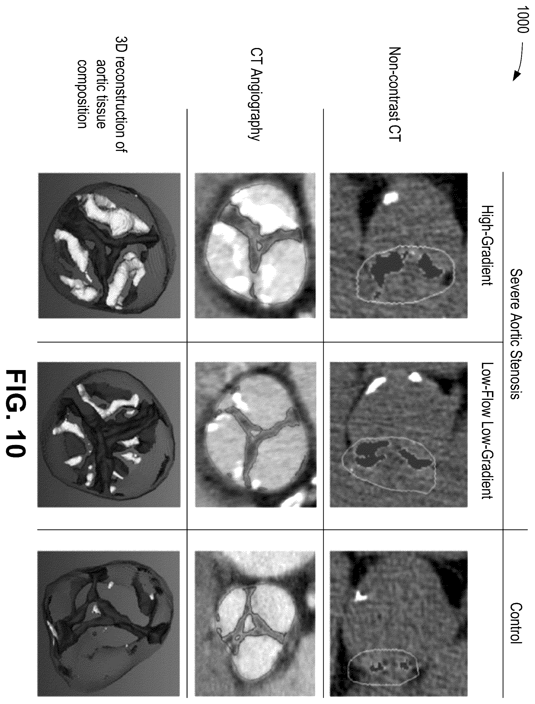 Patent US12376814 Figure 10 – Quantification of noncalcific and calcific valve tissue from coronary CT angiography
