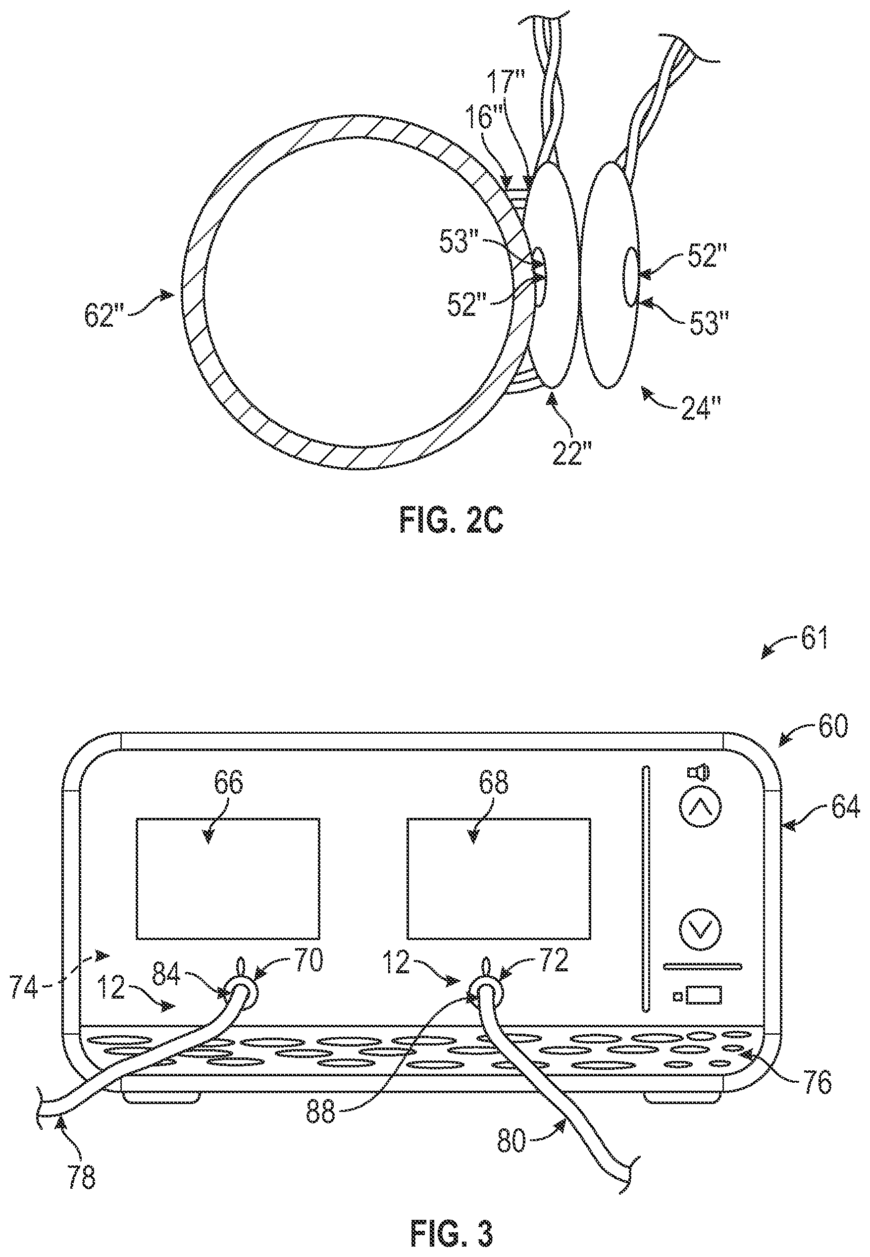 Patent US12376818 Figure 3 – Doppler probes, blood flow monitoring systems, and methods of monitoring blood flow