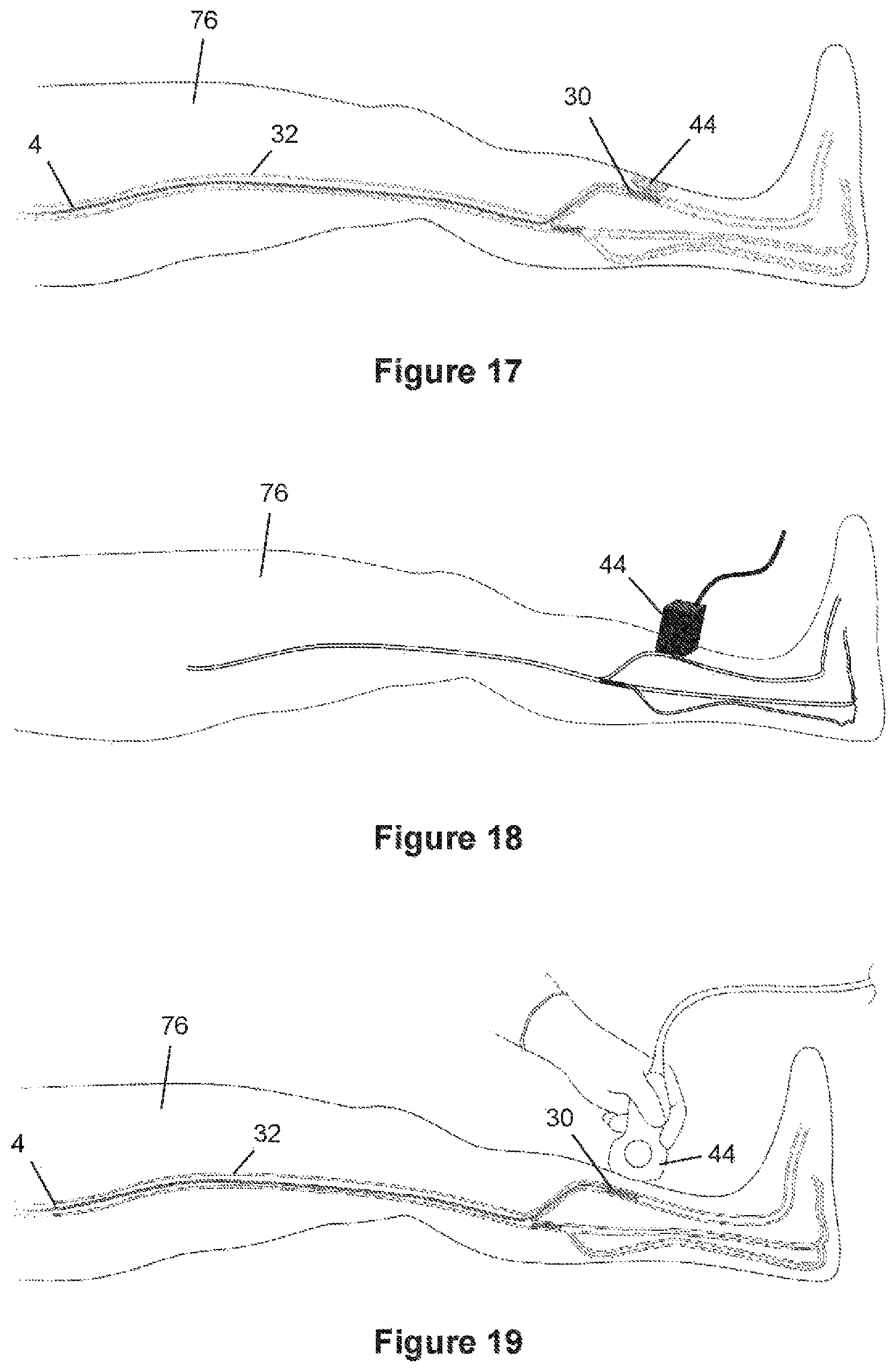 Patent US12376826 Figure 10 – Determining the condition of vessels in the body